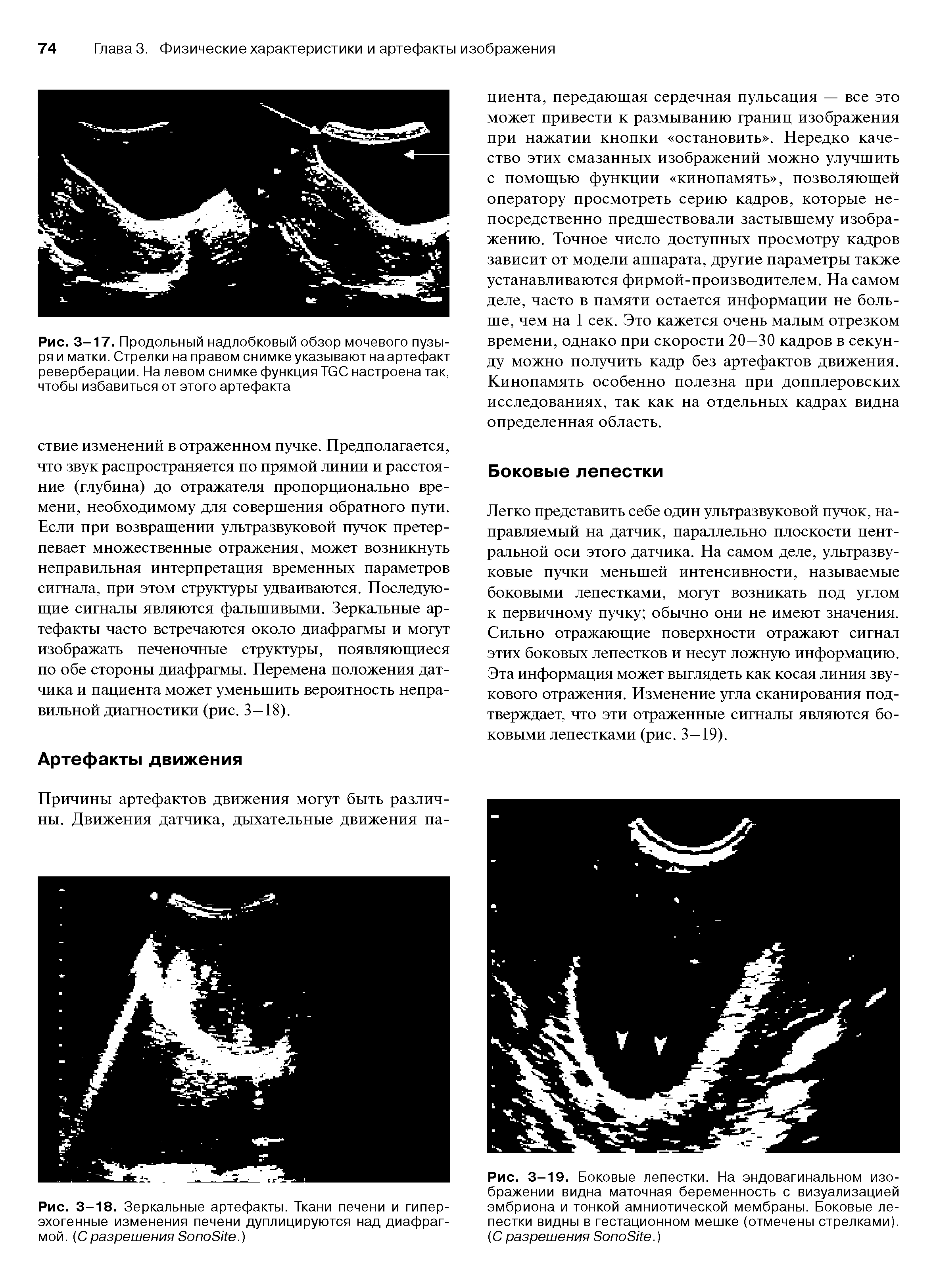 Рис. 3-18. Зеркальные артефакты. Ткани печени и гиперэхогенные изменения печени дуплицируются над диафрагмой. (Сразрешения БопоБ е.)...