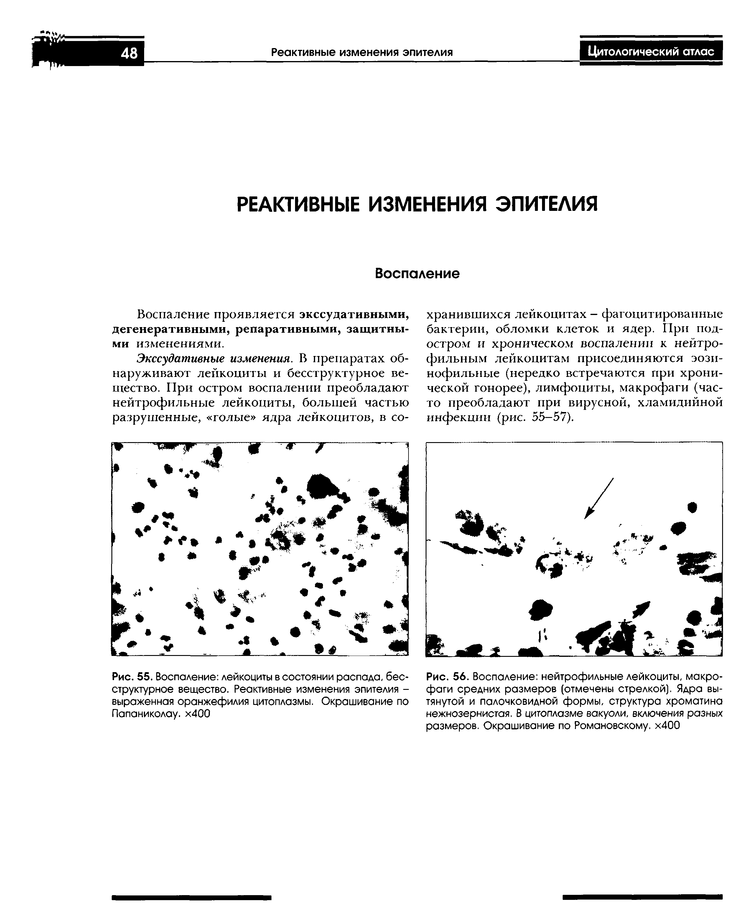 Рис. 56. Воспаление нейтрофильные лейкоциты, макрофаги средних размеров (отмечены стрелкой). Ядра вытянутой и палочковидной формы, структура хроматина нежнозернистая. В цитоплазме вакуоли, включения разных размеров. Окрашивание по Романовскому. х400...