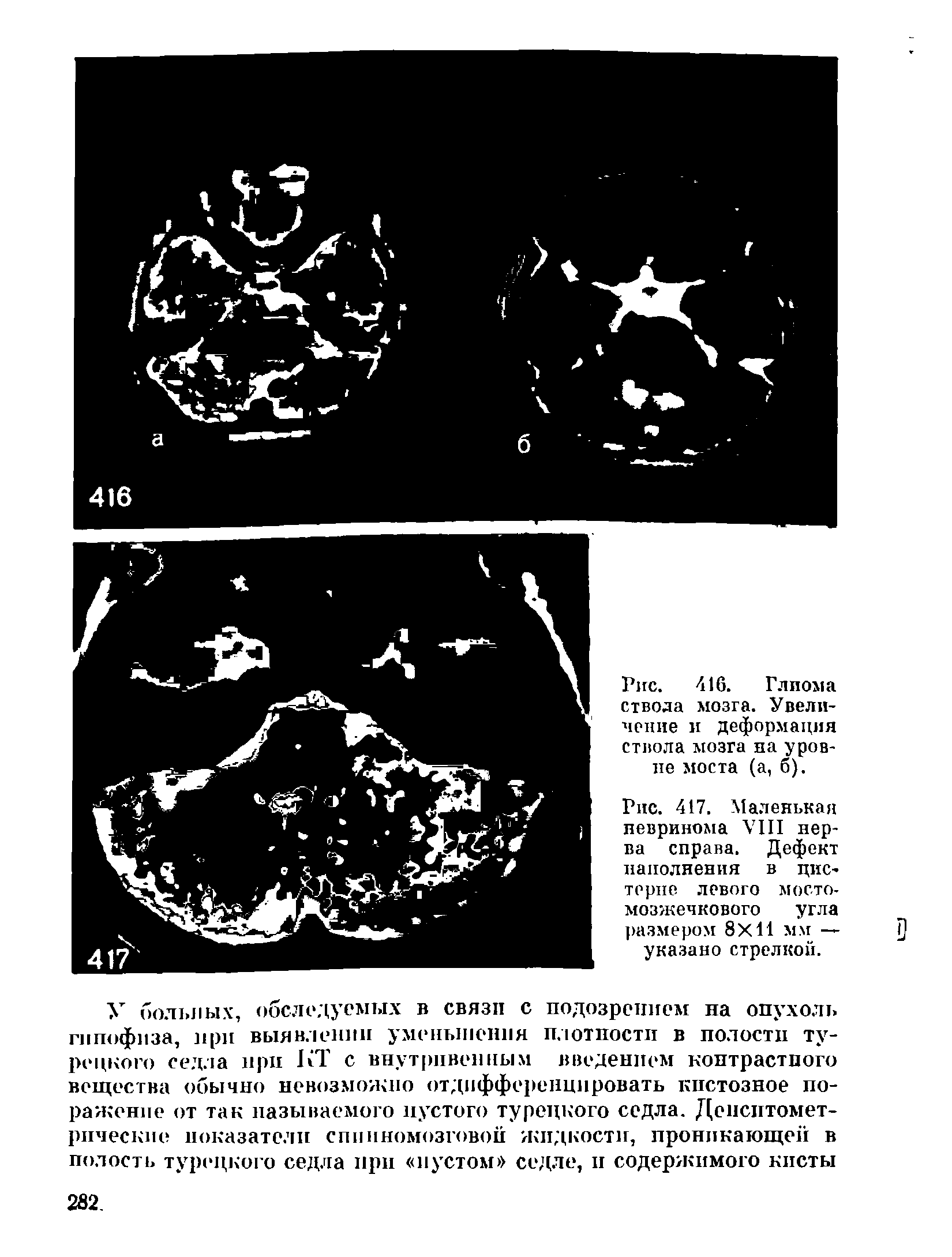 Рис. 416. Глиома ствола мозга. Увеличение и деформация ствола мозга иа уровне моста (а, б).