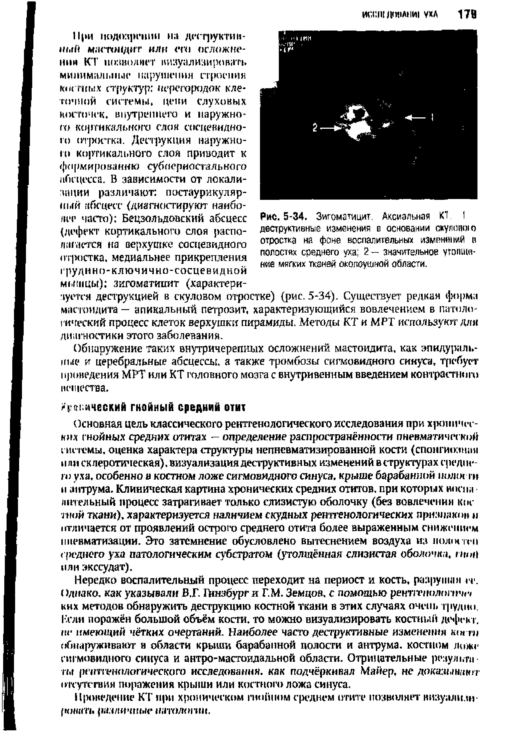 Рис. 5-34. Зигоматицит. Аксиальная КТ. I деструктивные изменения в основании скулою о отростка на фоне воспалительных изменений в полостях среднего уха 2 — значительное ушгицн-ние мягких тканей околоушной области.