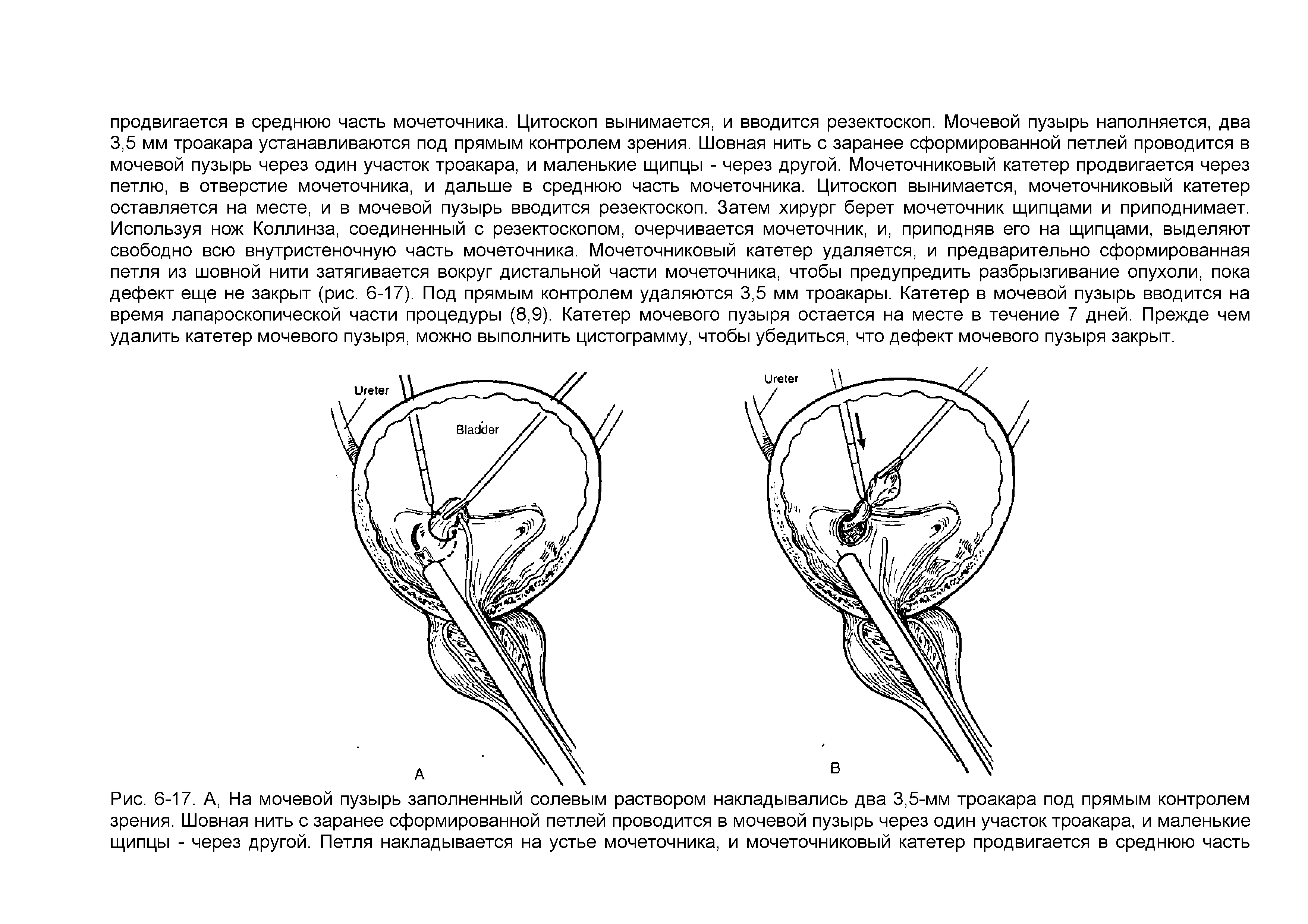 Рис. 6-17. А, На мочевой пузырь заполненный солевым раствором накладывались два 3,5-мм троакара под прямым контролем зрения. Шовная нить с заранее сформированной петлей проводится в мочевой пузырь через один участок троакара, и маленькие щипцы - через другой. Петля накладывается на устье мочеточника, и мочеточниковый катетер продвигается в среднюю часть...