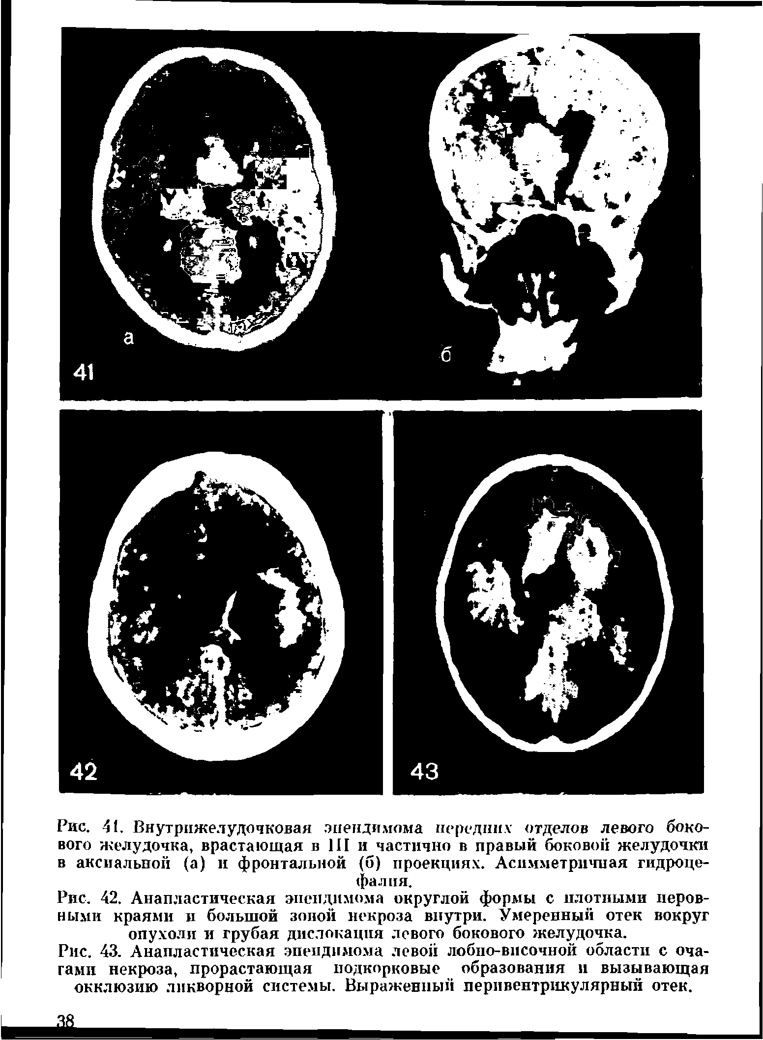 Рис. 42. Анапластическая эпендимома округлой формы с плотными неровными краями и большой зоной некроза внутри. Умеренный отек вокруг опухоли и грубая дислокация левого бокового желудочка.