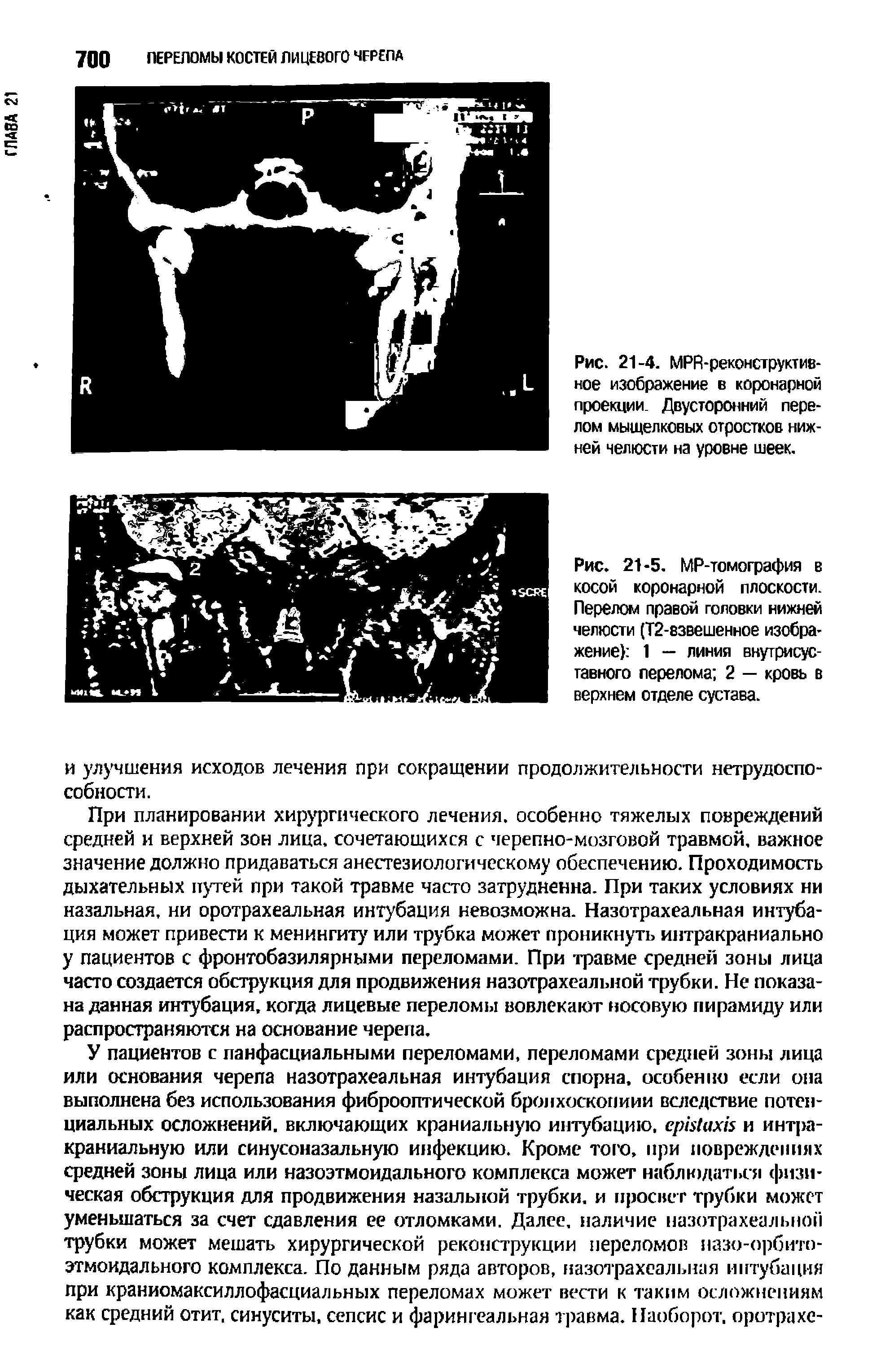 Рис. 21-4. МРА-реконс1 ру кт некое изображение в коронарной проекции. Двусторонний перелом мыщелковых отростков нижней челюсти на уровне шеек.