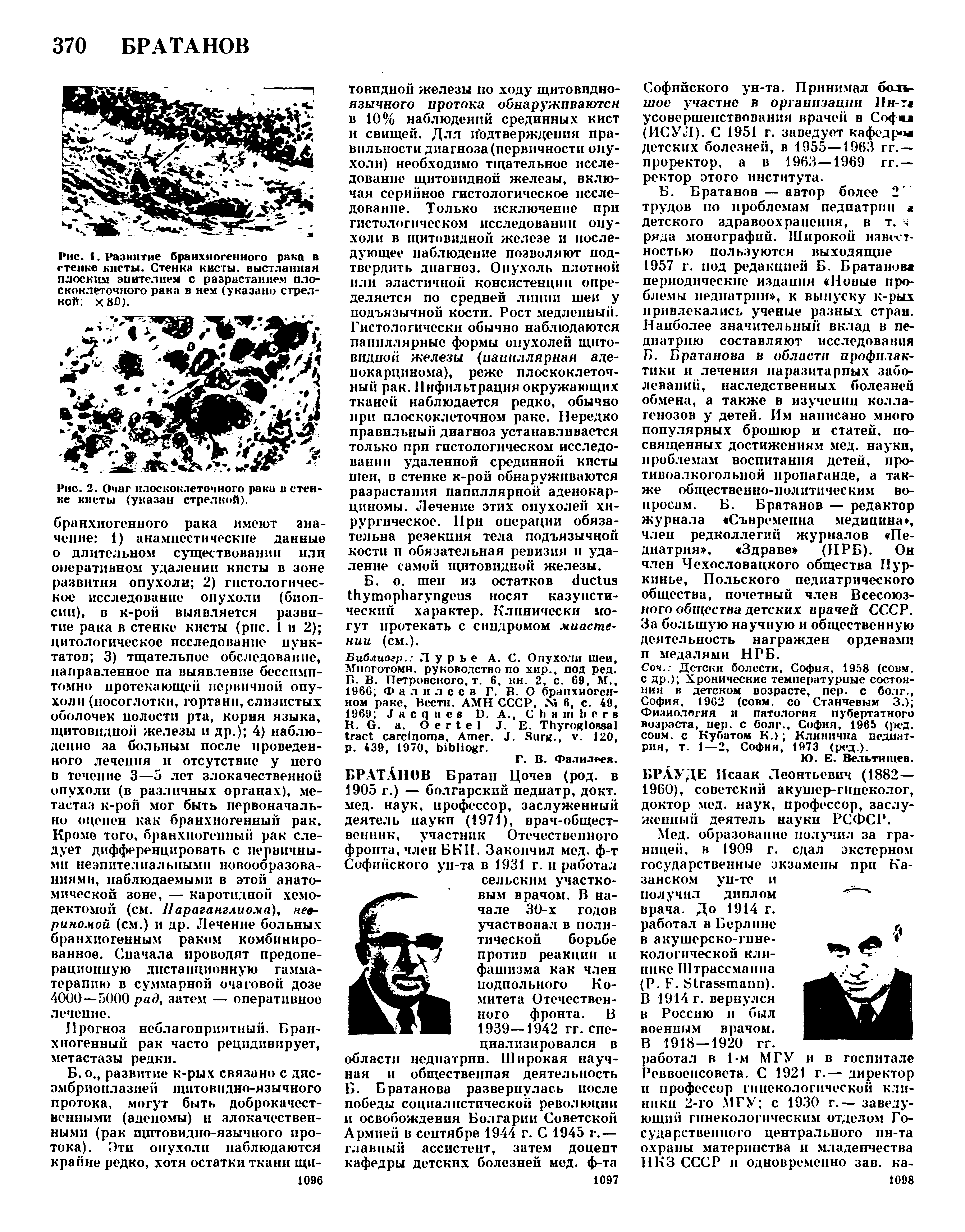 Рис. 1. Развитие бранхиогенного рака в стенке кисты. Стенка кисты, выстланная плоским эпителием с разрастанием плоскоклеточного рака в нем (указано стрелкой X 80).