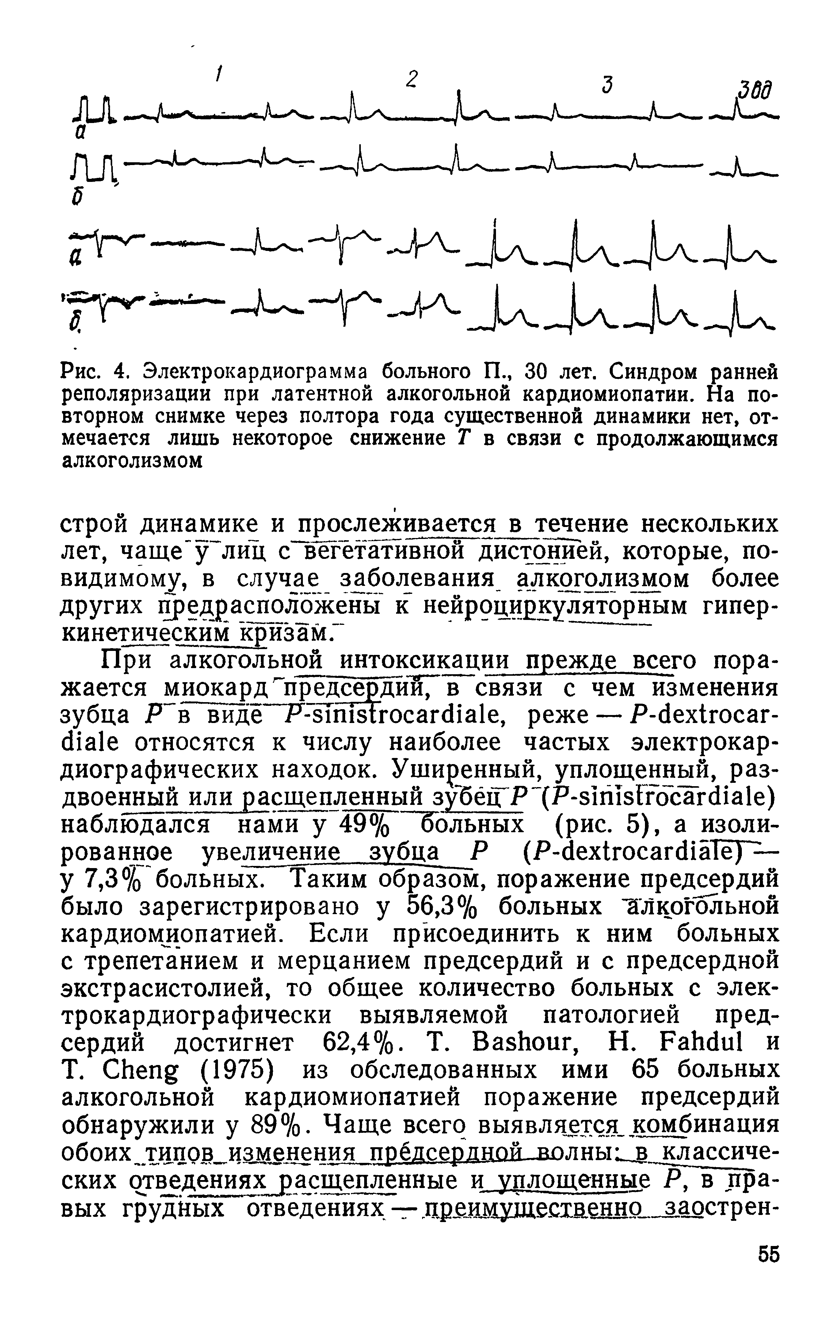 Рис. 4. Электрокардиограмма больного П., 30 лет. Синдром ранней реполяризации при латентной алкогольной кардиомиопатии. На повторном снимке через полтора года существенной динамики нет, отмечается лишь некоторое снижение Т в связи с продолжающимся алкоголизмом...