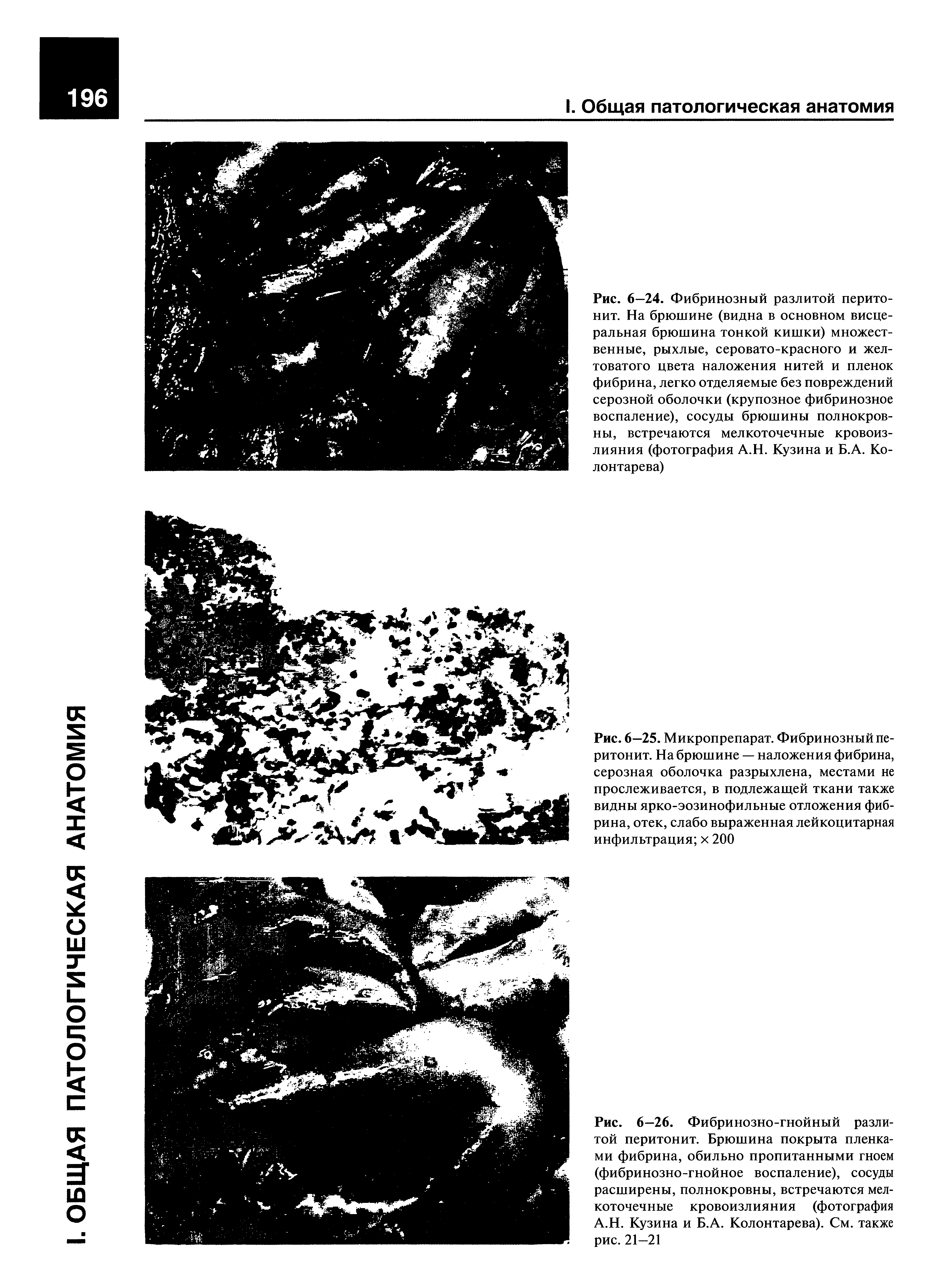 Рис. 6—25. Микропрепарат. Фибринозный перитонит. На брюшине — наложения фибрина, серозная оболочка разрыхлена, местами не прослеживается, в подлежащей ткани также видны ярко-эозинофильные отложения фибрина, отек, слабо выраженная лейкоцитарная инфильтрация х 200...