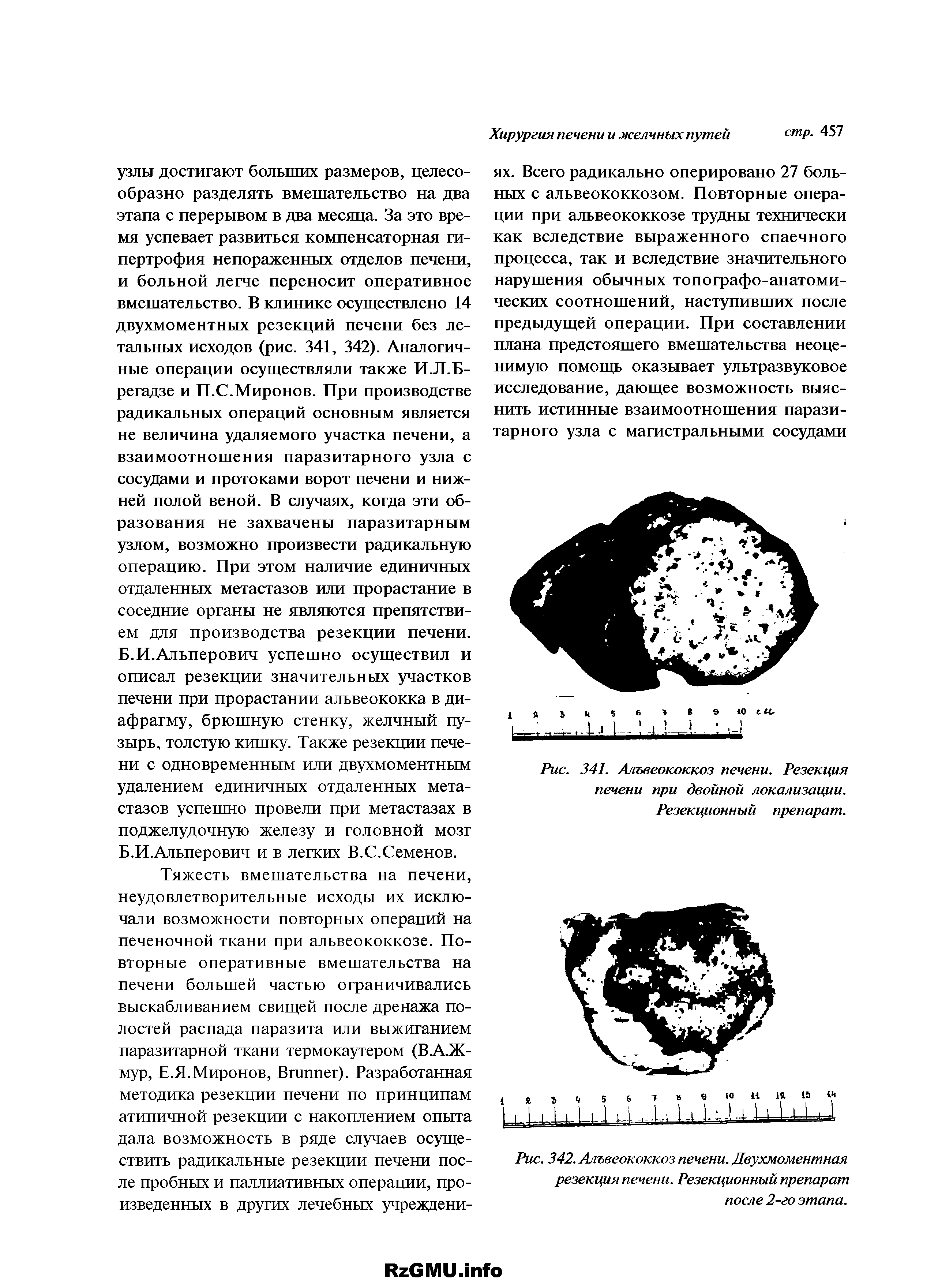 Рис. 341. Альвеококкоз печени. Резекция печени при двойной локализации. Резекционный препарат.