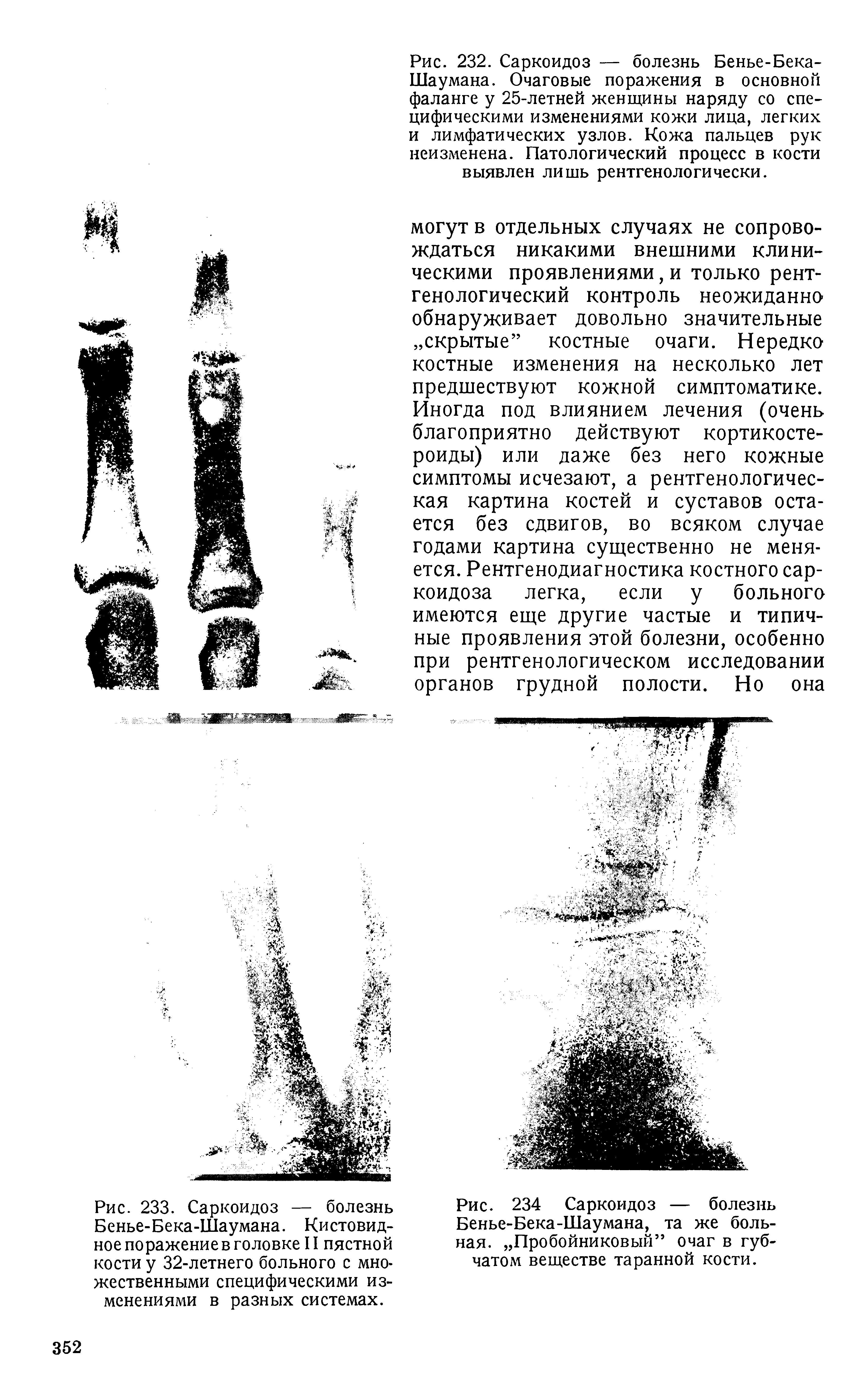 Рис. 234 Саркоидоз — болезнь Бенье-Бека-Шаумана, та же больная. Пробойниковый очаг в губчатом веществе таранной кости.