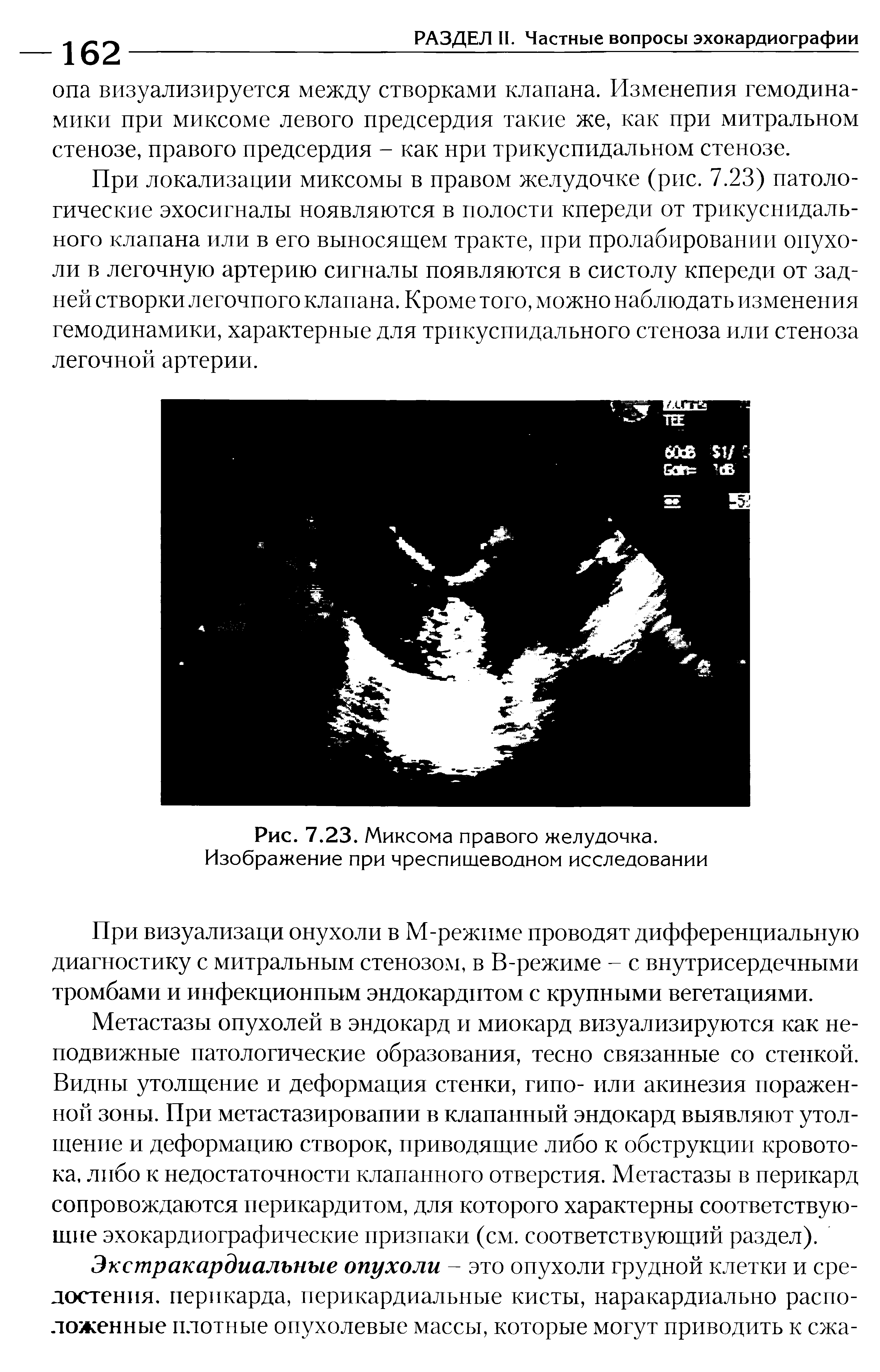 Рис. 7.23. Миксома правого желудочка. Изображение при чреспищеводном исследовании...