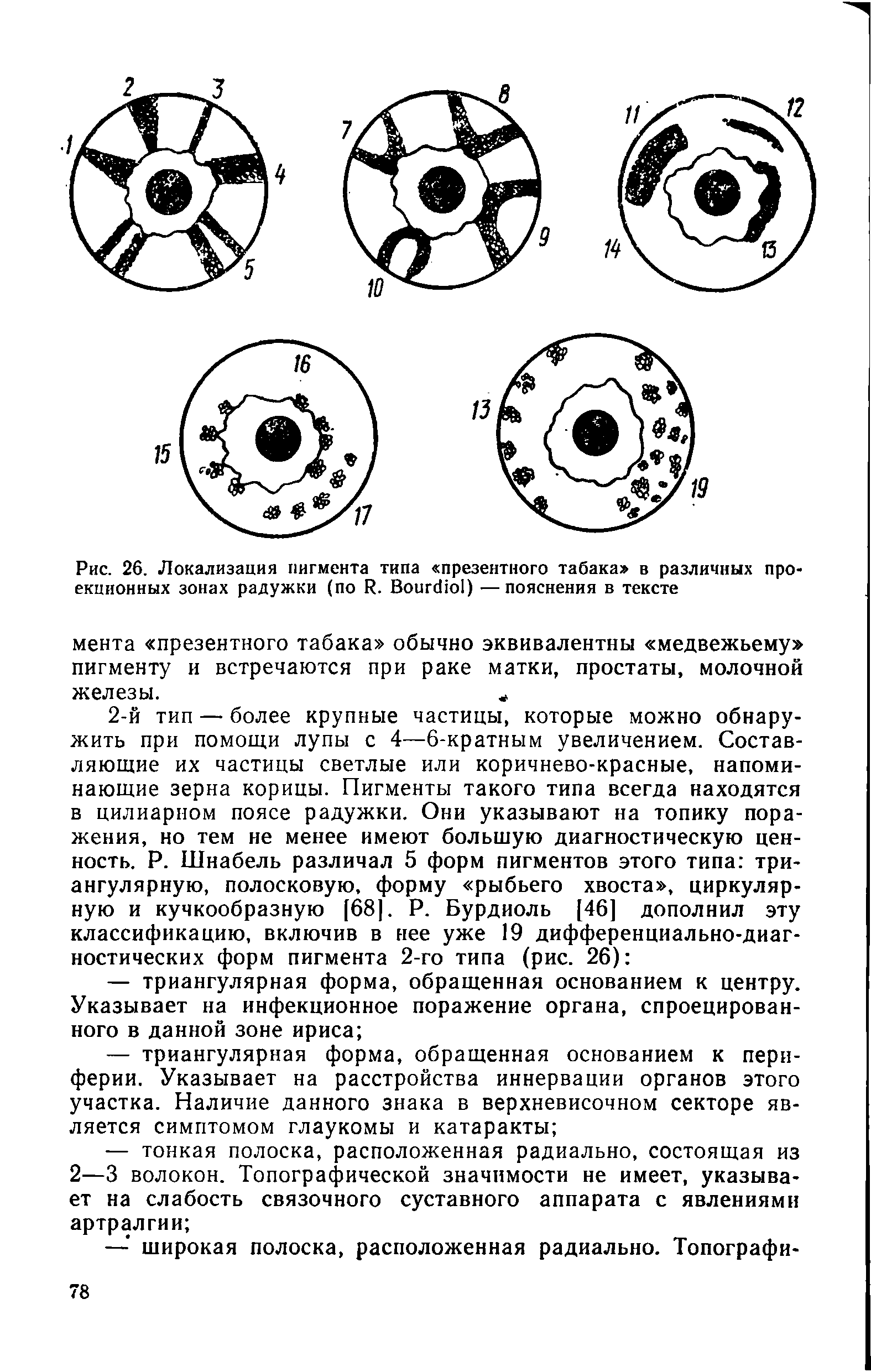 Рис. 26. Локализация пигмента типа презентного табака в различных проекционных зонах радужки (по И. ВоигсПо ) —пояснения в тексте...