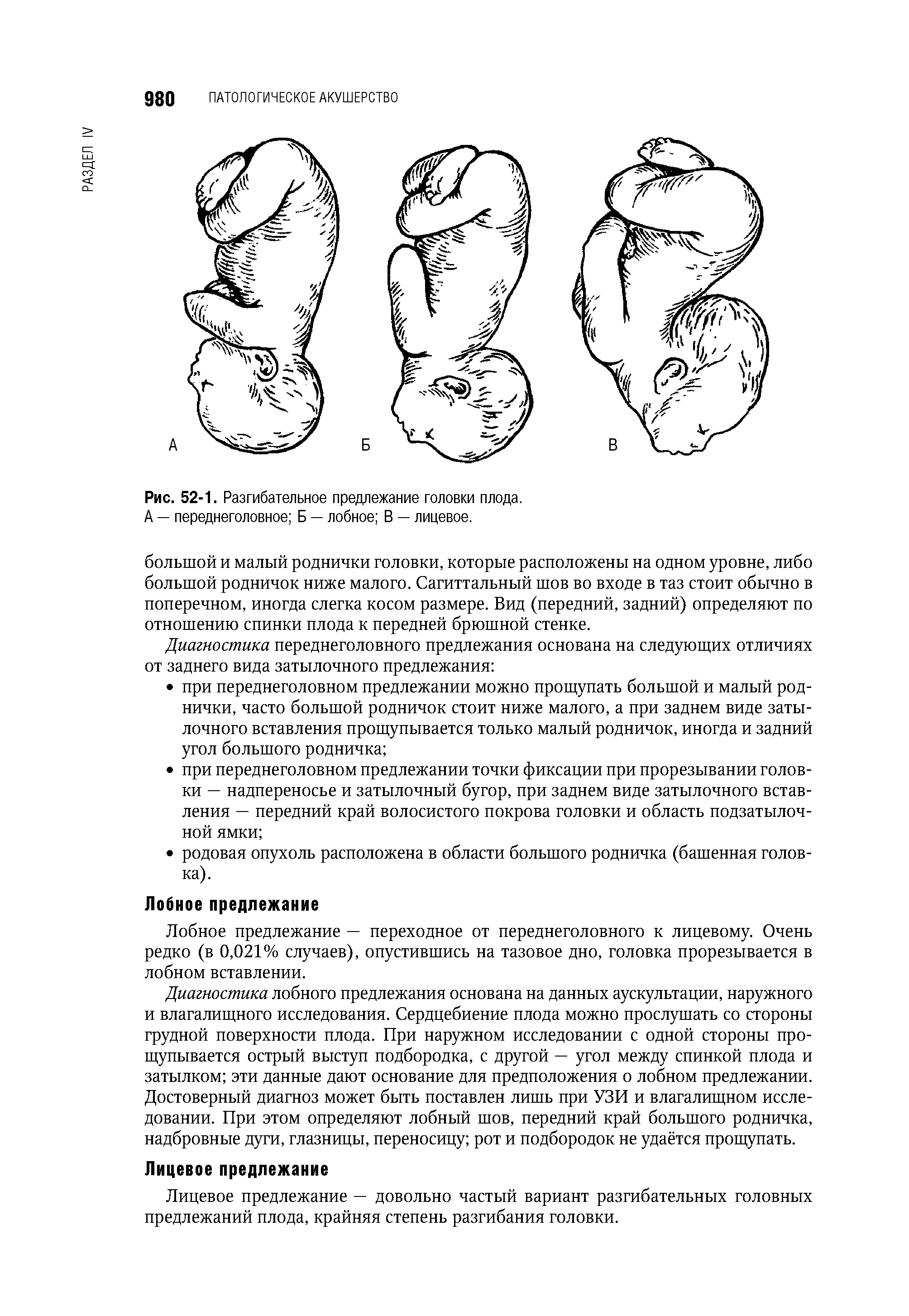 Рис. 52-1. Разгибательное предлежание головки плода. А — переднеголовное Б — лобное В — лицевое.