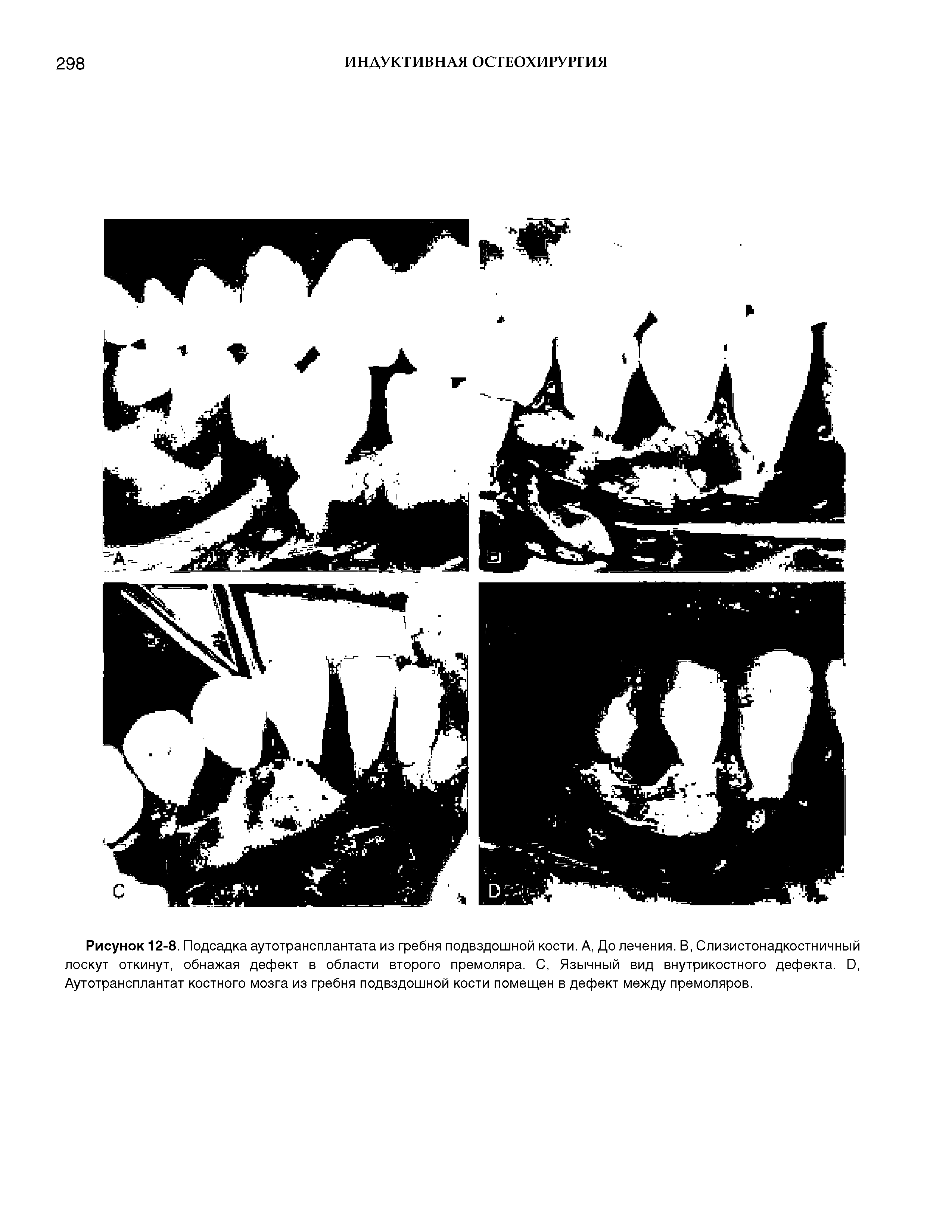 Рисунок 12-8. Подсадка аутотрансплантата из гребня подвздошной кости. А, До лечения. В, Слизистонадкостничный лоскут откинут, обнажая дефект в области второго премоляра. С, Язычный вид внутрикостного дефекта. О, Аутотрансплантат костного мозга из гребня подвздошной кости помещен в дефект между премоляров.