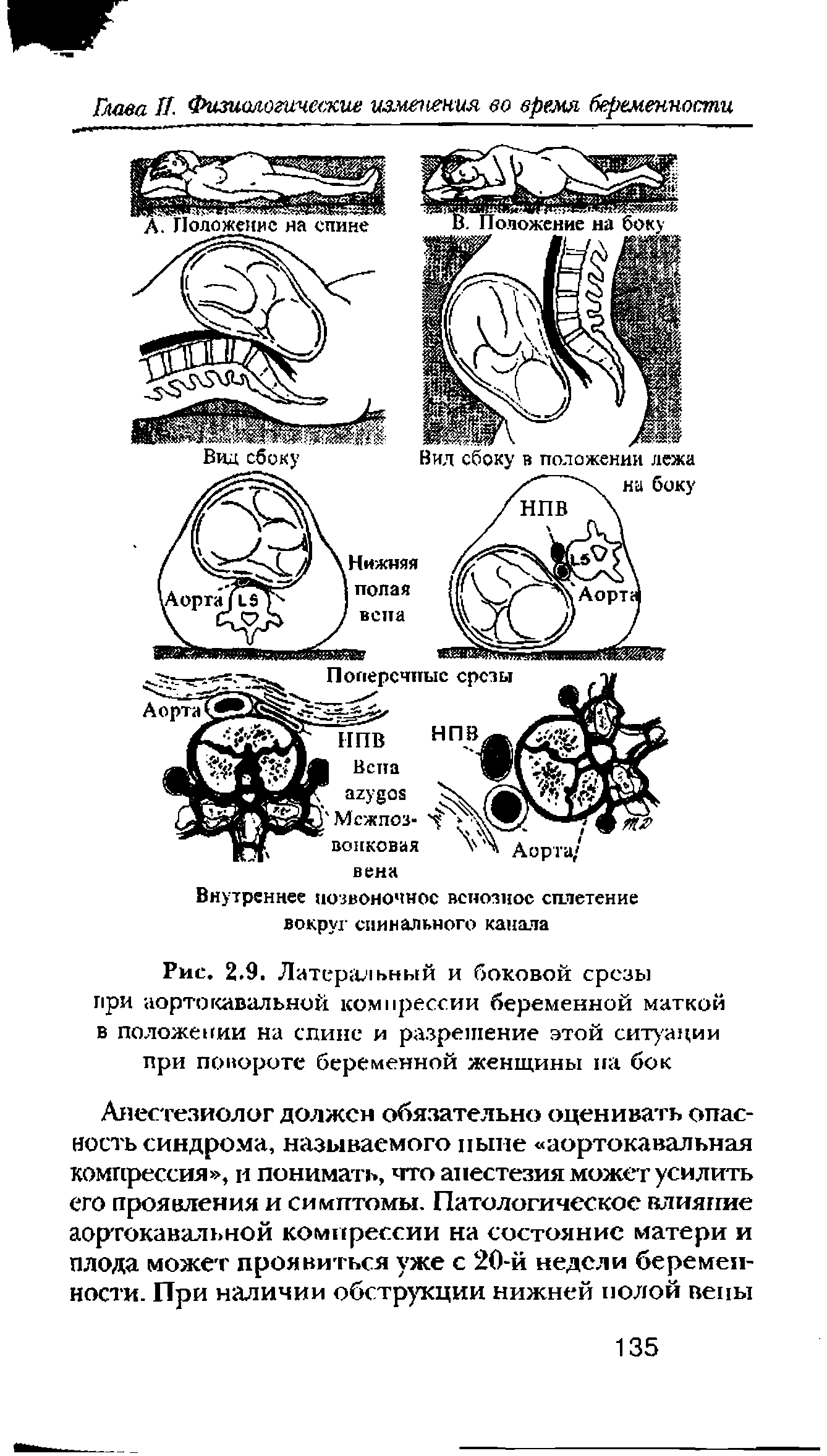 Рис. 2.9. Латеральный и боковой срезы при порто кавальной компрессии беременной маткой в положении на спине и разрешение этой ситуации при повороте беременной женщины па бок...