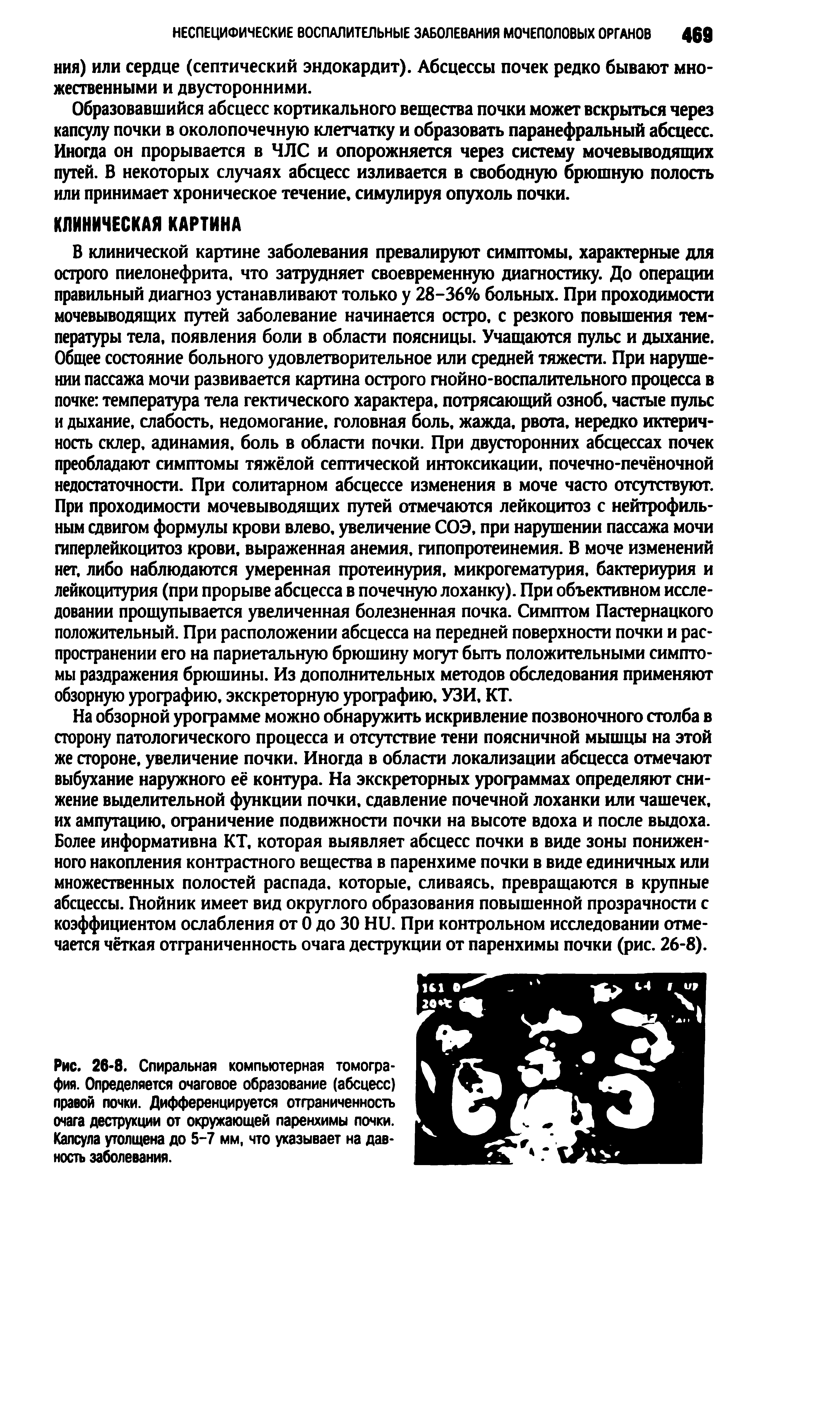 Рис. 26-8. Спиральная компьютерная томография. Определяется очаговое образование (абсцесс) правой почки. Дифференцируется отграниченность очага деструхции от окружающей паренхимы почки. Капсула утолщена до 5-7 мм, что указывает на давность заболевания.