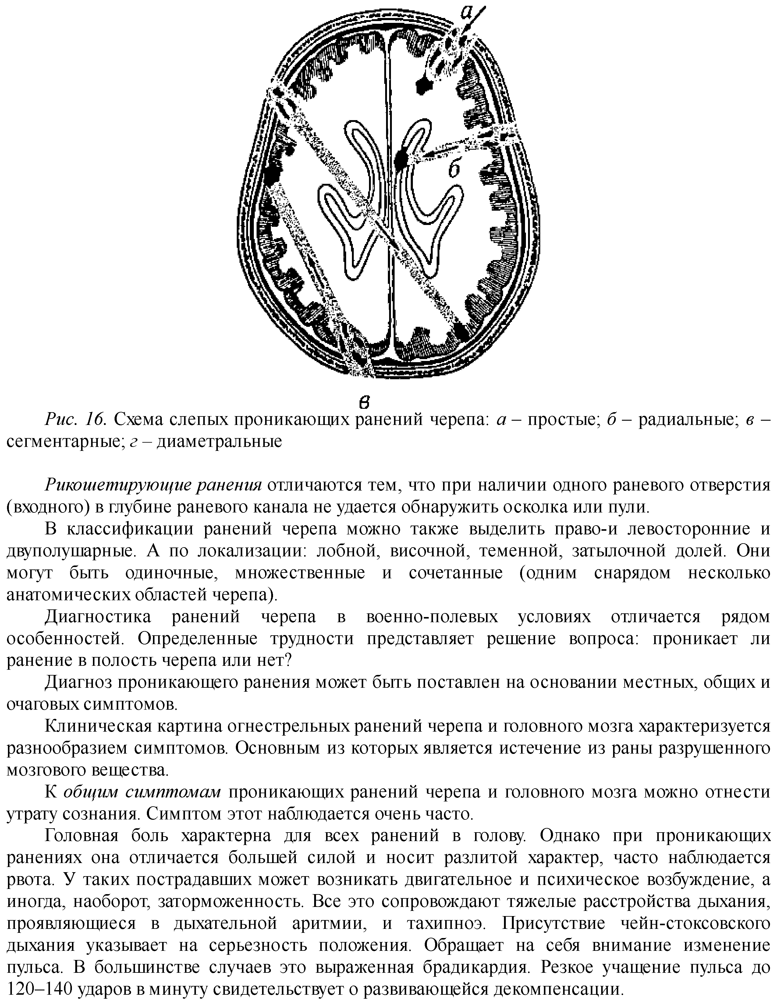 Рис. 16. Схема слепых проникающих ранений черепа а - простые б - радиальные в -сегментарные г - диаметральные...