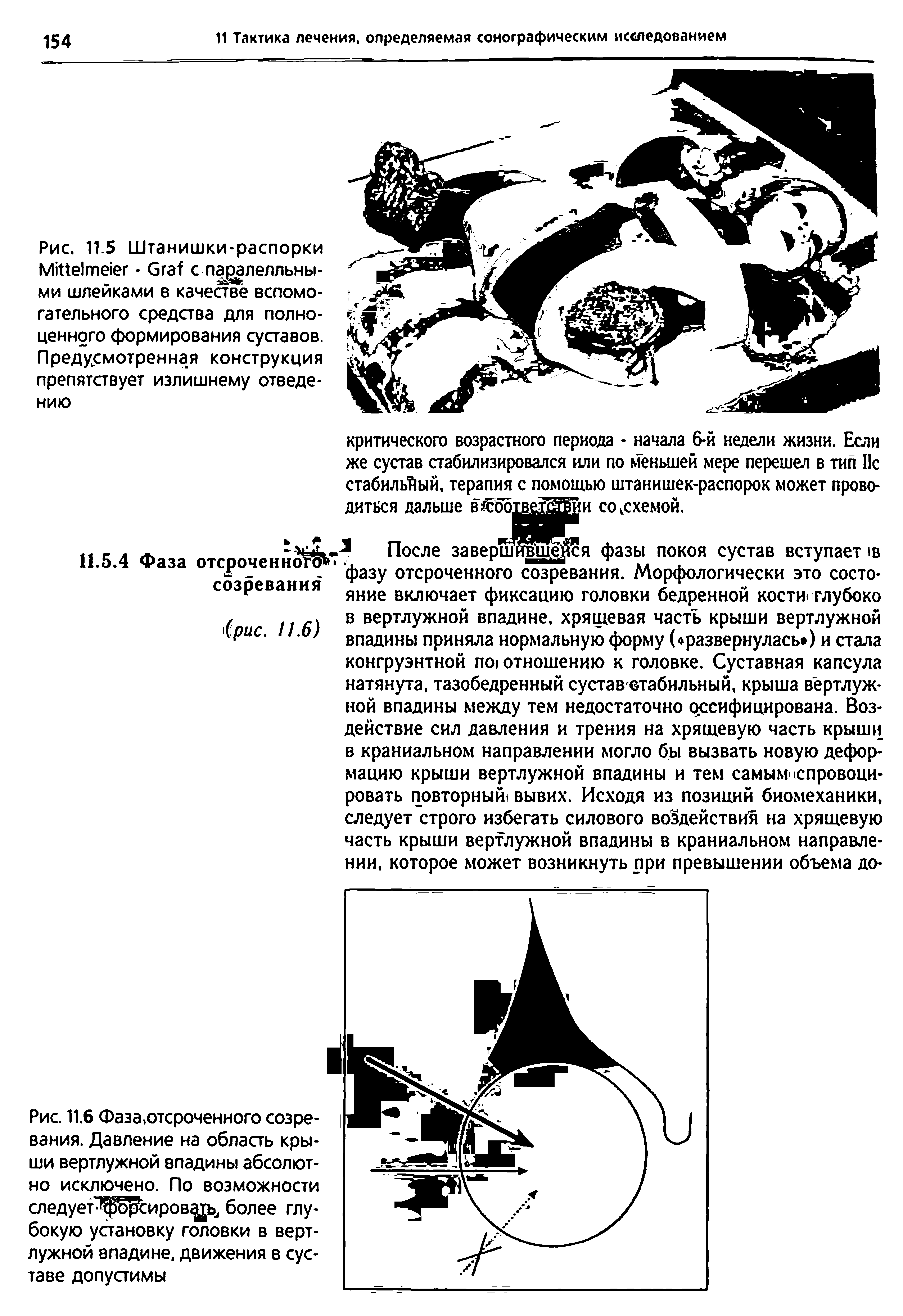 Рис. 11.6 Фаза.отсроченного созревания. Давление на область крыши вертлужной впадины абсолютно исключено. По возможности следует ор сировадь, более глубокую установку головки в вертлужной впадине, движения в суставе допустимы...