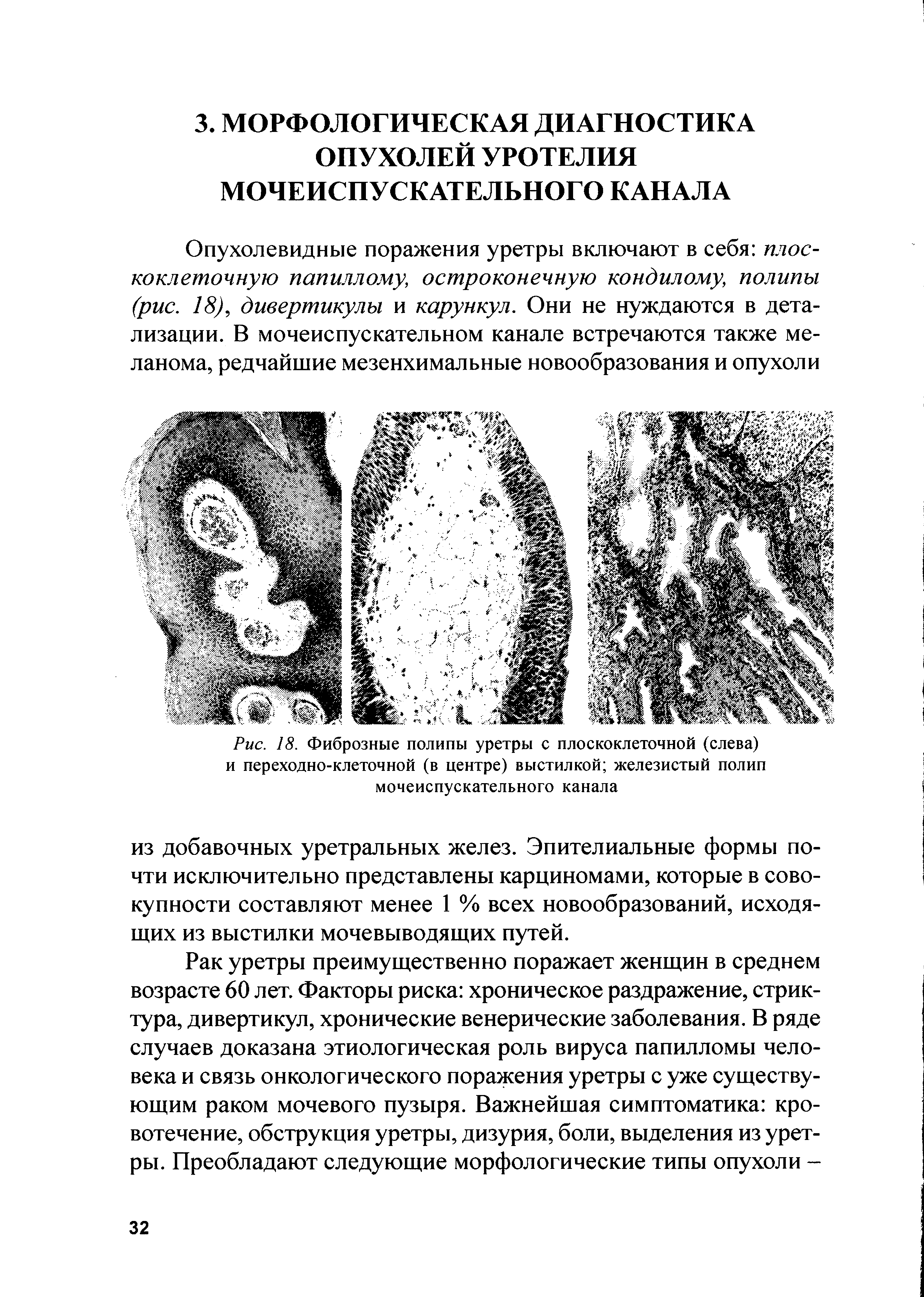 Рис. 18. Фиброзные полипы уретры с плоскоклеточной (слева) и переходно-клеточной (в центре) выстилкой железистый полип мочеиспускательного канала...