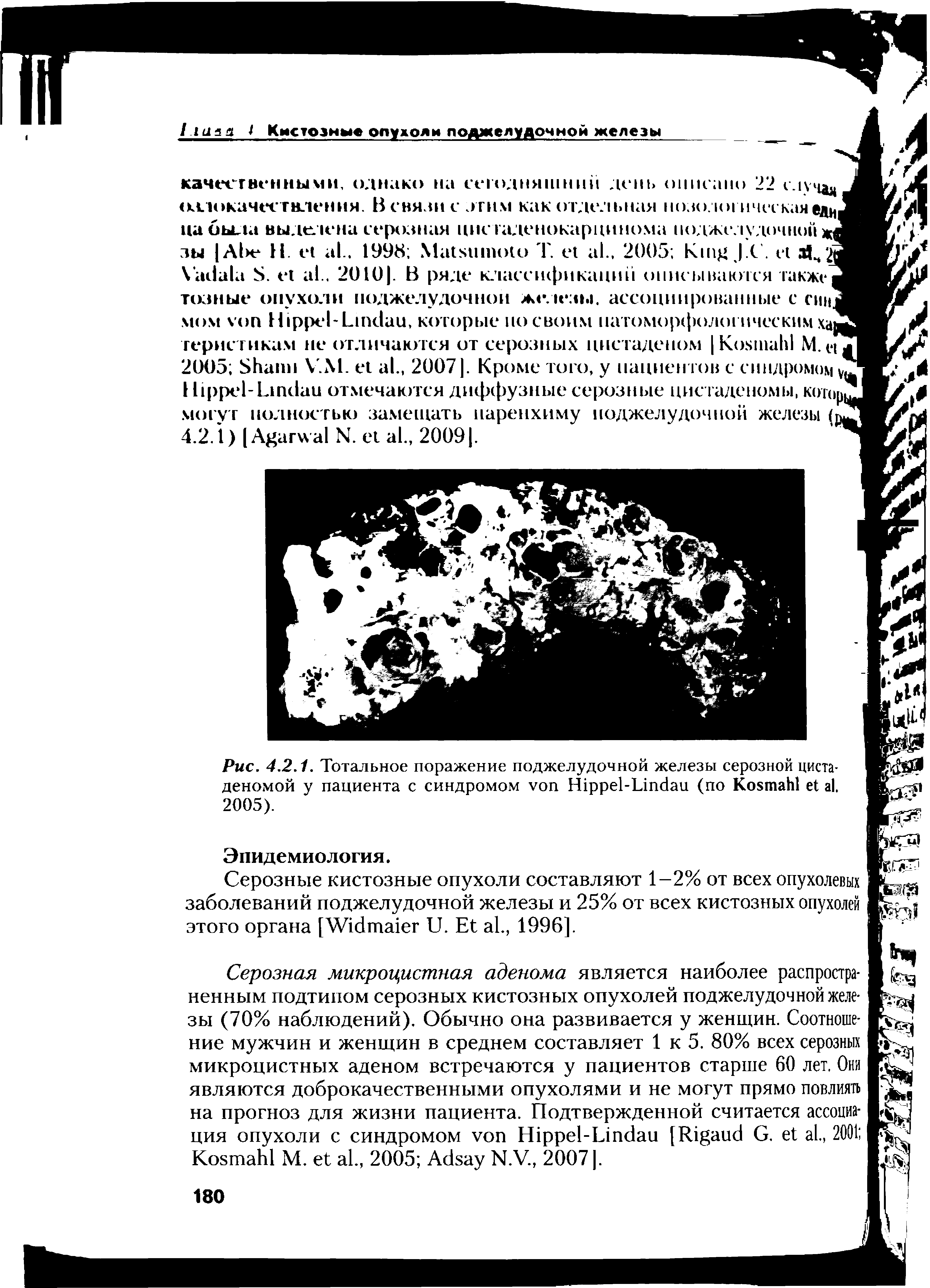 Рис. 4.2.1. Тотальное поражение поджелудочной железы серозной циста деномой у пациента с синдромом H -L (по K . 2005).