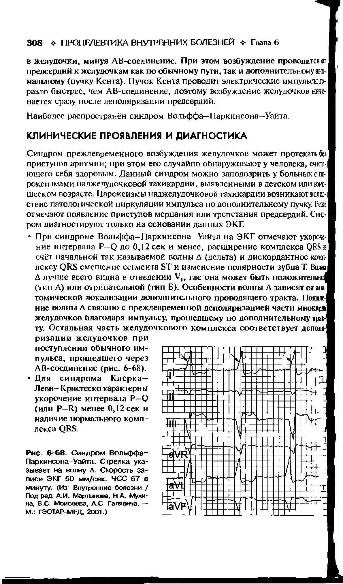 Рис. 6-68. Синдром Вольффа-Паркинсона-Уайта. Стрелка указывает на волну А. Скорость записи ЭКГ 50 мм/сек. ЧСС 67 в минуту. (Из Внутренние болезни / Под ред. А.И. Мартынова, Н А. Мухина, В. С. Моисеева, А.С Галявича. — М. ГЭОТАР-МЕД, 2001.)...