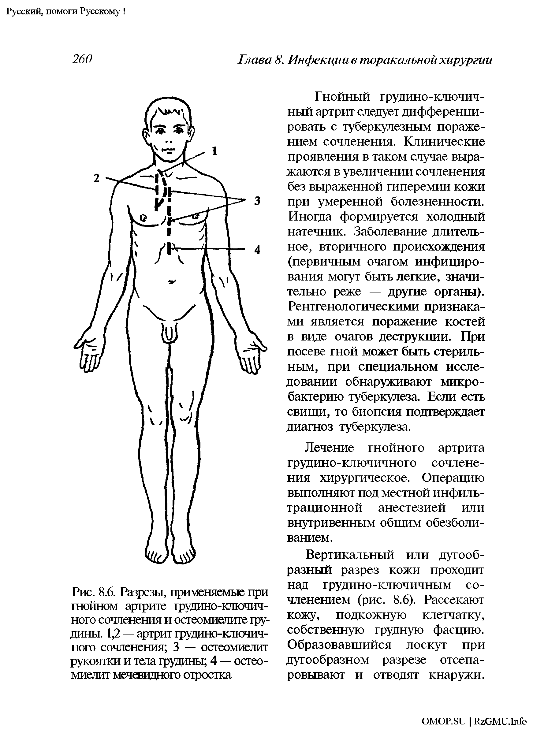 Рис. 8.6. Разрезы, применяемые при гнойном артрите грудино-ключичного сочленения и остеомиелите грудины. 1,2 — артрит грудино-ключичного сочленения 3 — остеомиелит рукоятки и тела грудины 4 — остеомиелит мечевидного отростка...