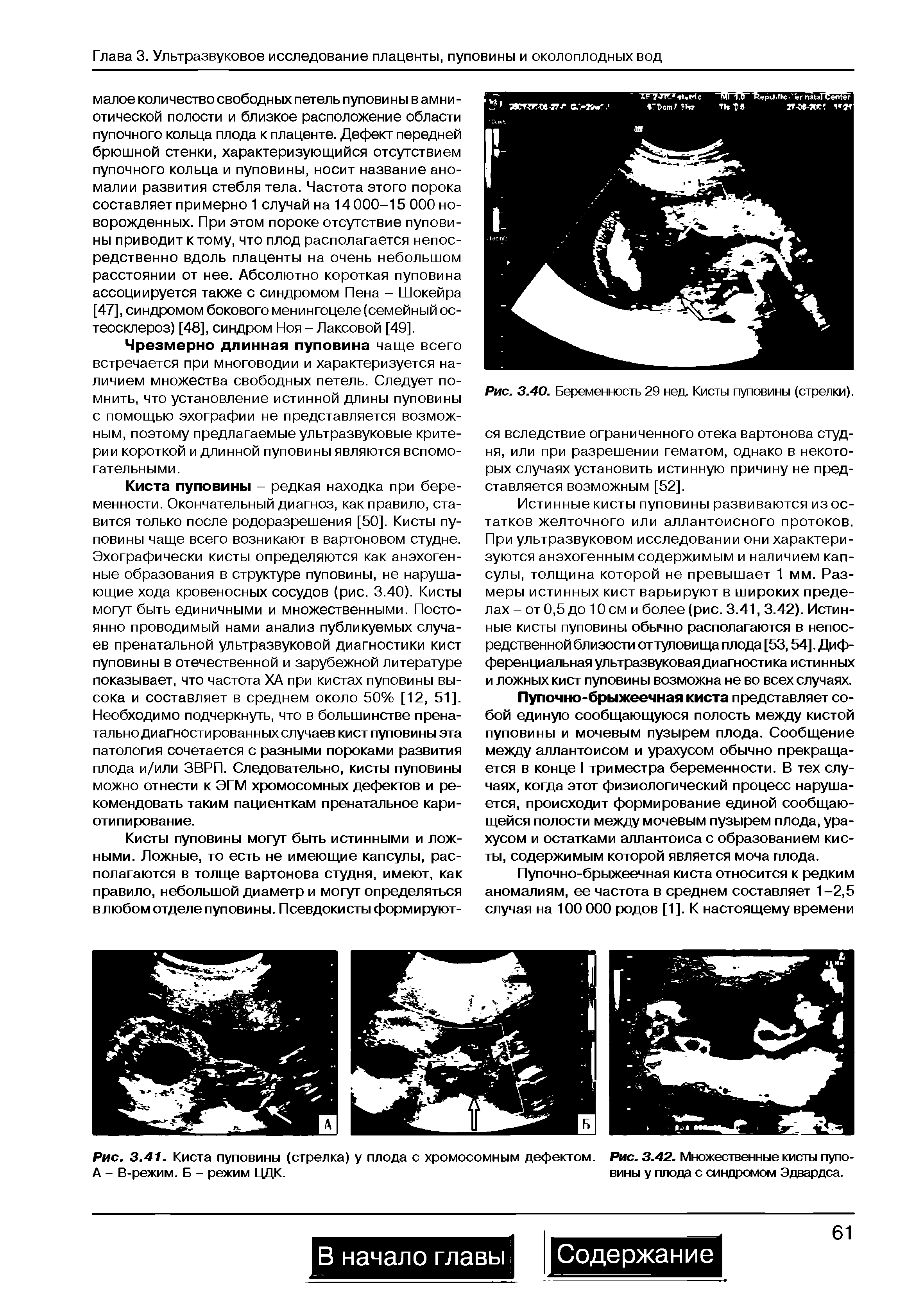 Рис. 3.41. Киста пуповины (стрелка) у плода с хромосомным дефектом. Рис. 3.42. Множественные кисты пупо-А - В-режим. Б - режим ЦДК. вины у плода с синдромом Эдвардса.