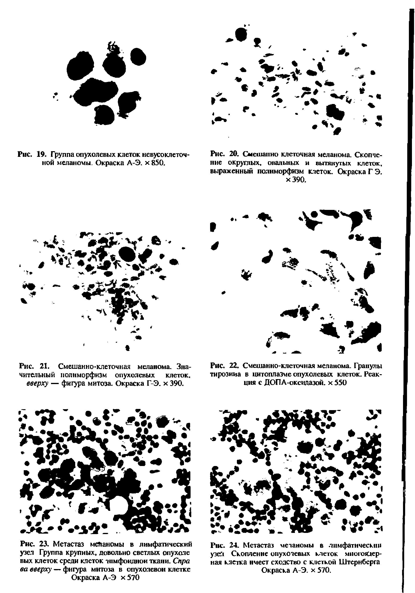 Рис. 23. Метастаз меланомы в лимфатический узел Группа крупных, довольно светлых опухоле вых клеток среди клеток тпмфоиднои ткани. Спра ва вверху — фигура митоза в опухолевой клетке Окраска А-Э х 570...