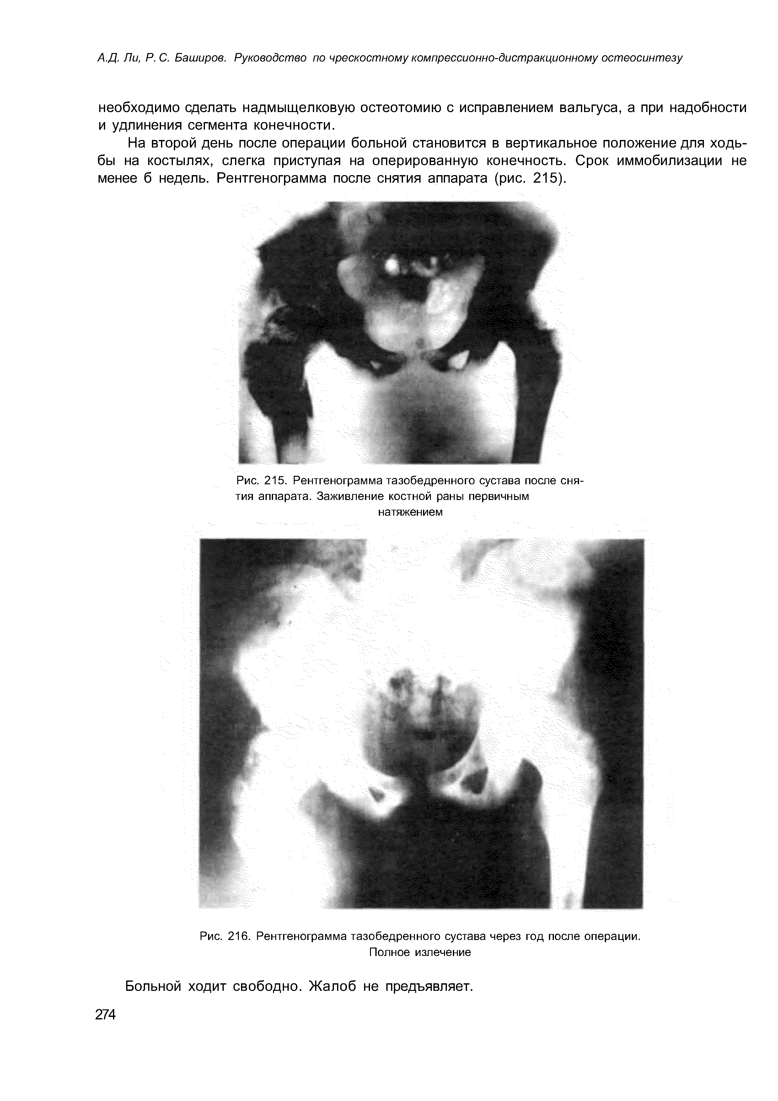 Рис. 215. Рентгенограмма тазобедренного сустава после снятия аппарата. Заживление костной раны первичным натяжением...
