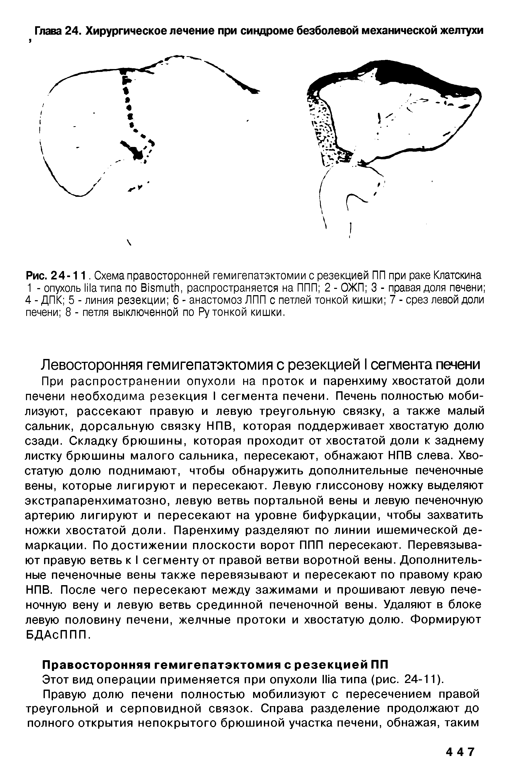 Рис. 24-11. Схема правосторонней гемигепатэктомии с резекцией ПП при раке Клатскина 1 - опухоль типа по B , распространяется на ППП 2 - ОЖП 3 - правая доля печени 4 - ДПК 5 - линия резекции 6 - анастомоз ППП с петлей тонкой кишки 7 - срез левой доли печени 8 - петля выключенной по Ру тонкой кишки.