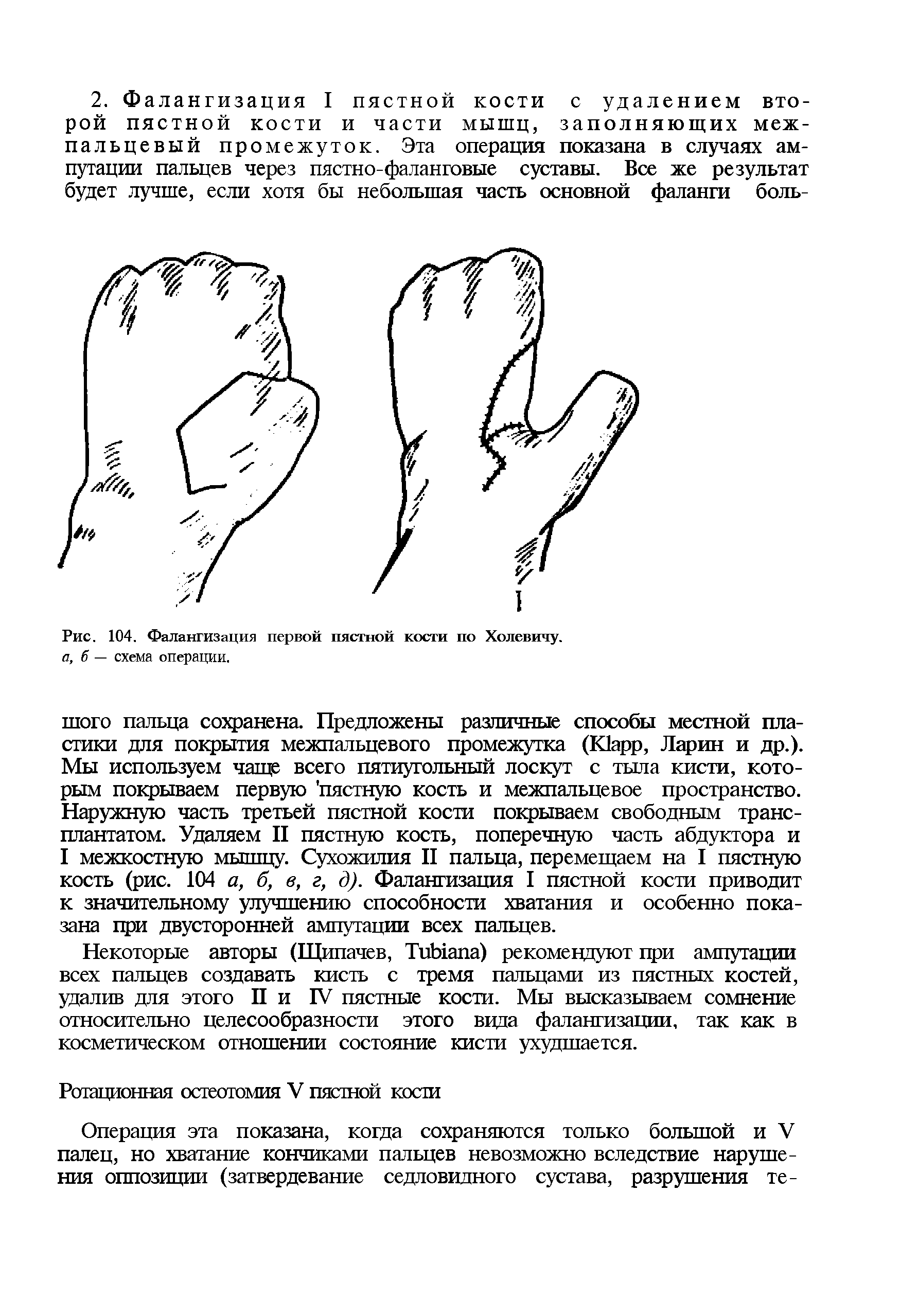 Рис. 104. Фалангизация первой пястной кости по Холевичу. а, б — схема операции.