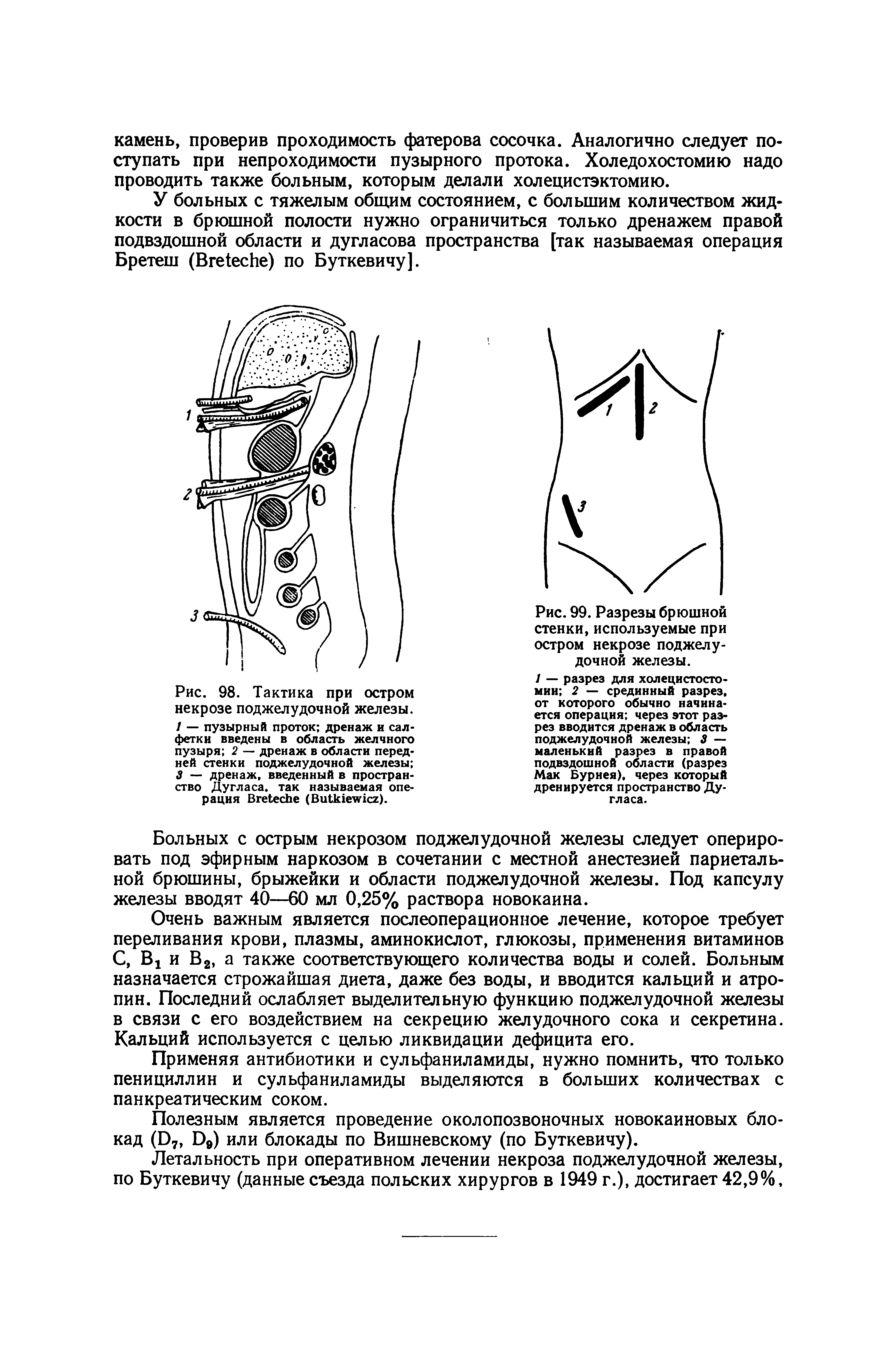 Рис. 98. Тактика при остром некрозе поджелудочной железы. 1 — пузырный проток дренаж и салфетки введены в область желчного пузыря 2 — дренаж в области передней стенки поджелудочной железы 3 — дренаж, введенный в пространство Дугласа, так называемая операция ВгеЬесЬе (Ви1к1е 1сг).