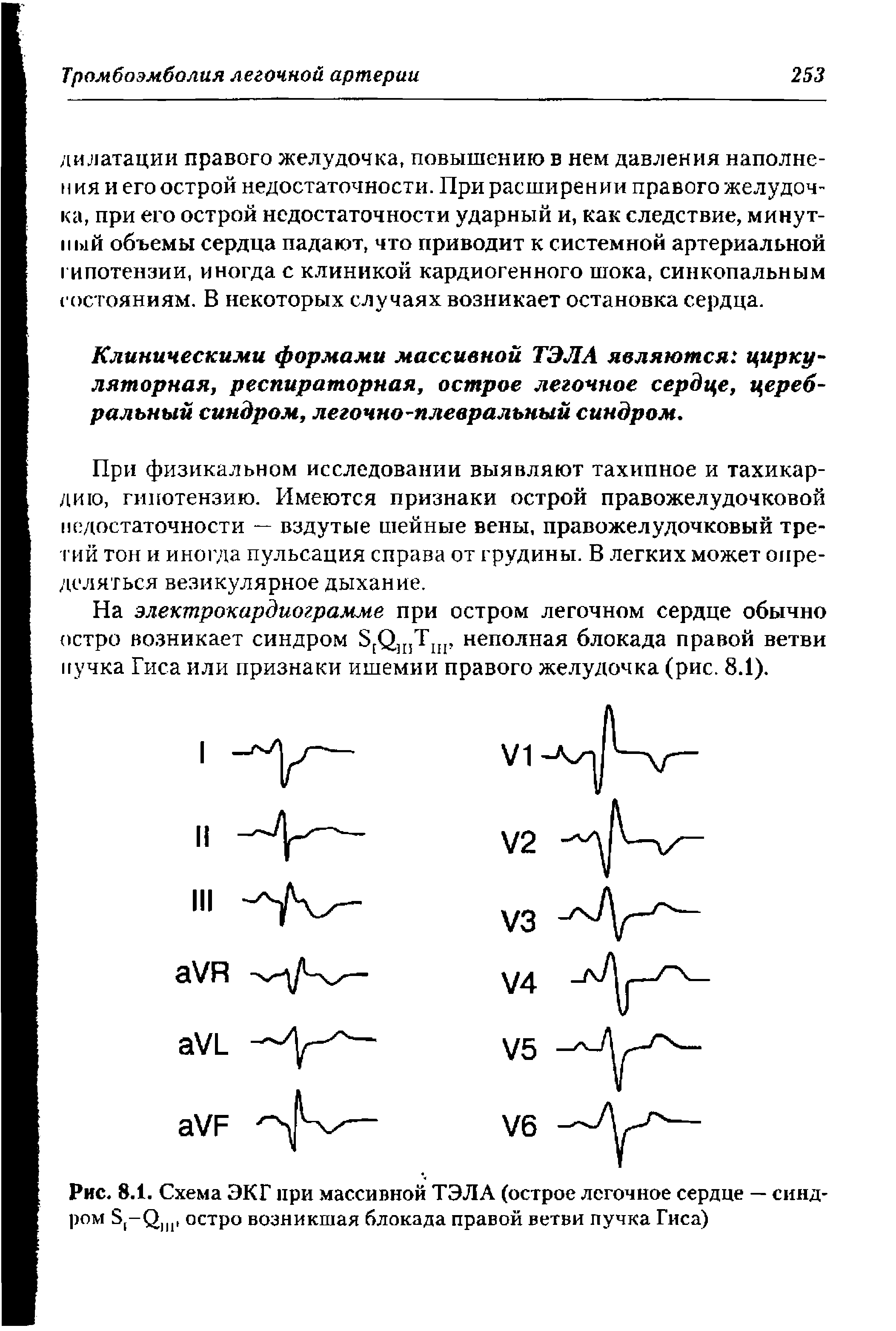 Рис. 8.1. Схема ЭКГ при массивной ТЭЛА (острое легочное сердце — синдром остро возникшая блокада правой ветви пучка Гиса)...