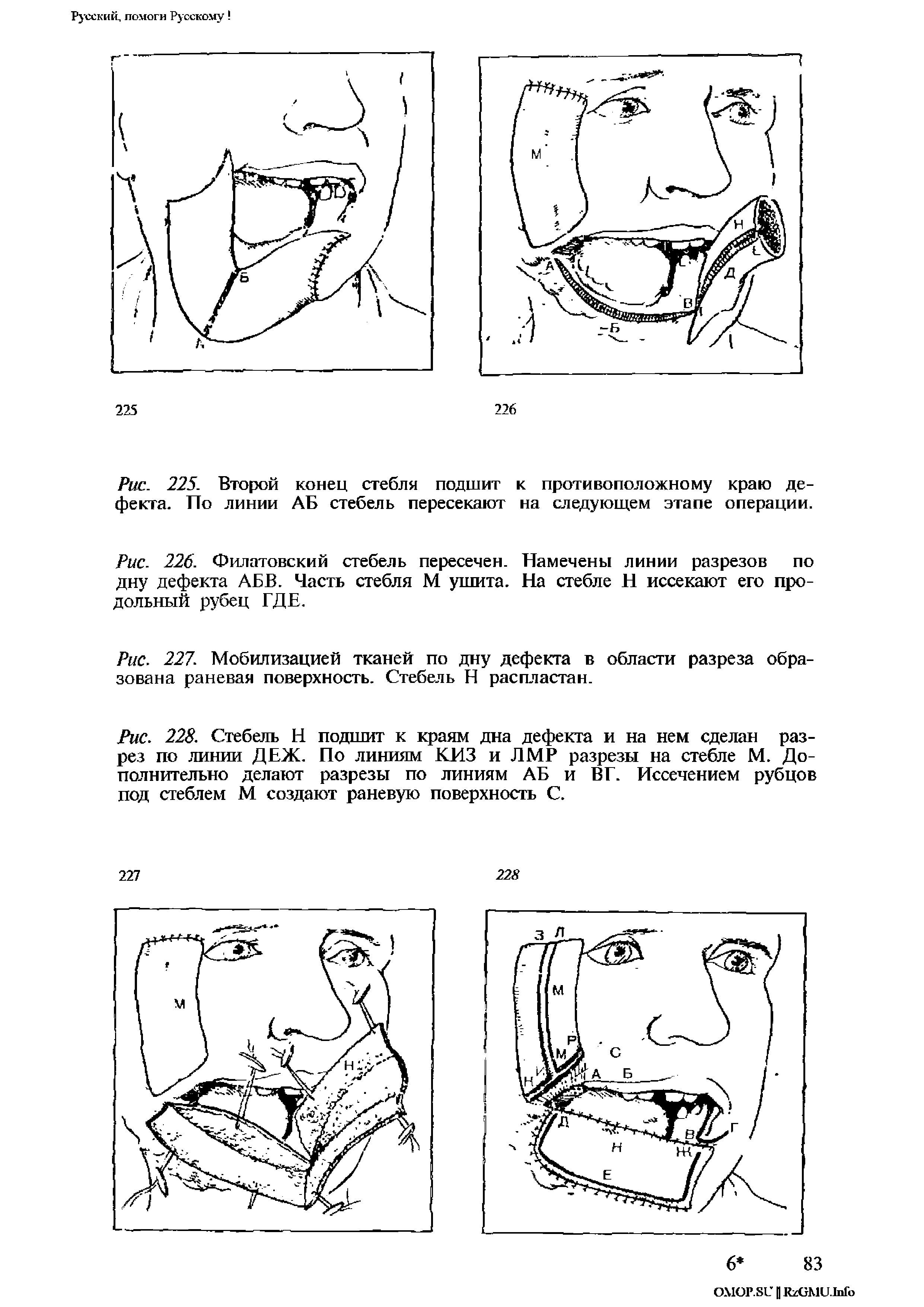 Рис. 226. Филатовский стебель пересечен. Намечены линии разрезов по дну дефекта АБВ. Часть стебля М ушита. На стебле Н иссекают его продольный рубец ГДЕ.