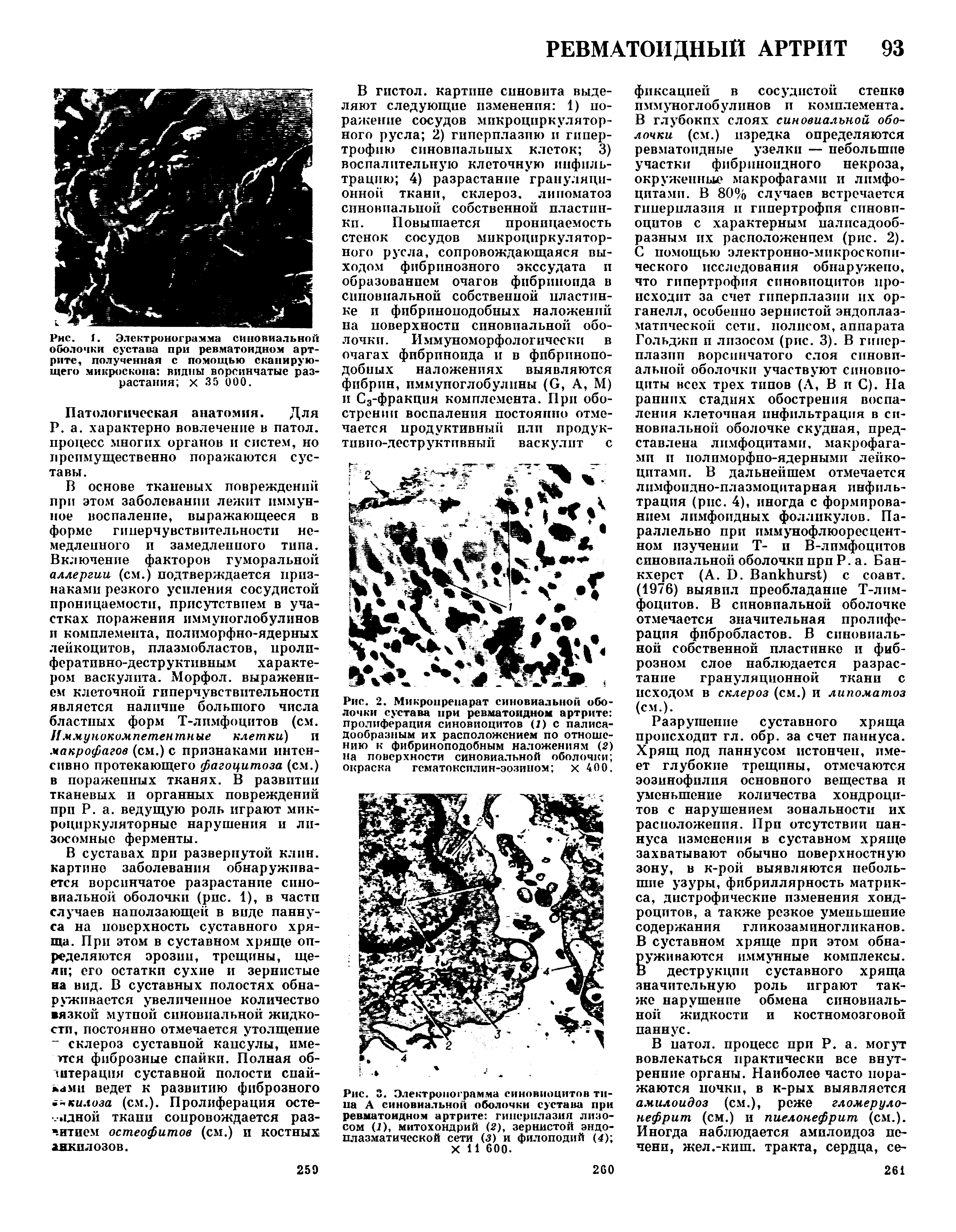 Рис. 2. Микропрепарат синовиальной оболочки сустава при ревматоидном артрите пролиферация синовиоцитов (7) с палисадообразным их расположением по отношению к фибриноподобным наложениям (2) на поверхности синовиальной оболочки окраска гсматоксплин-эозином х 400.