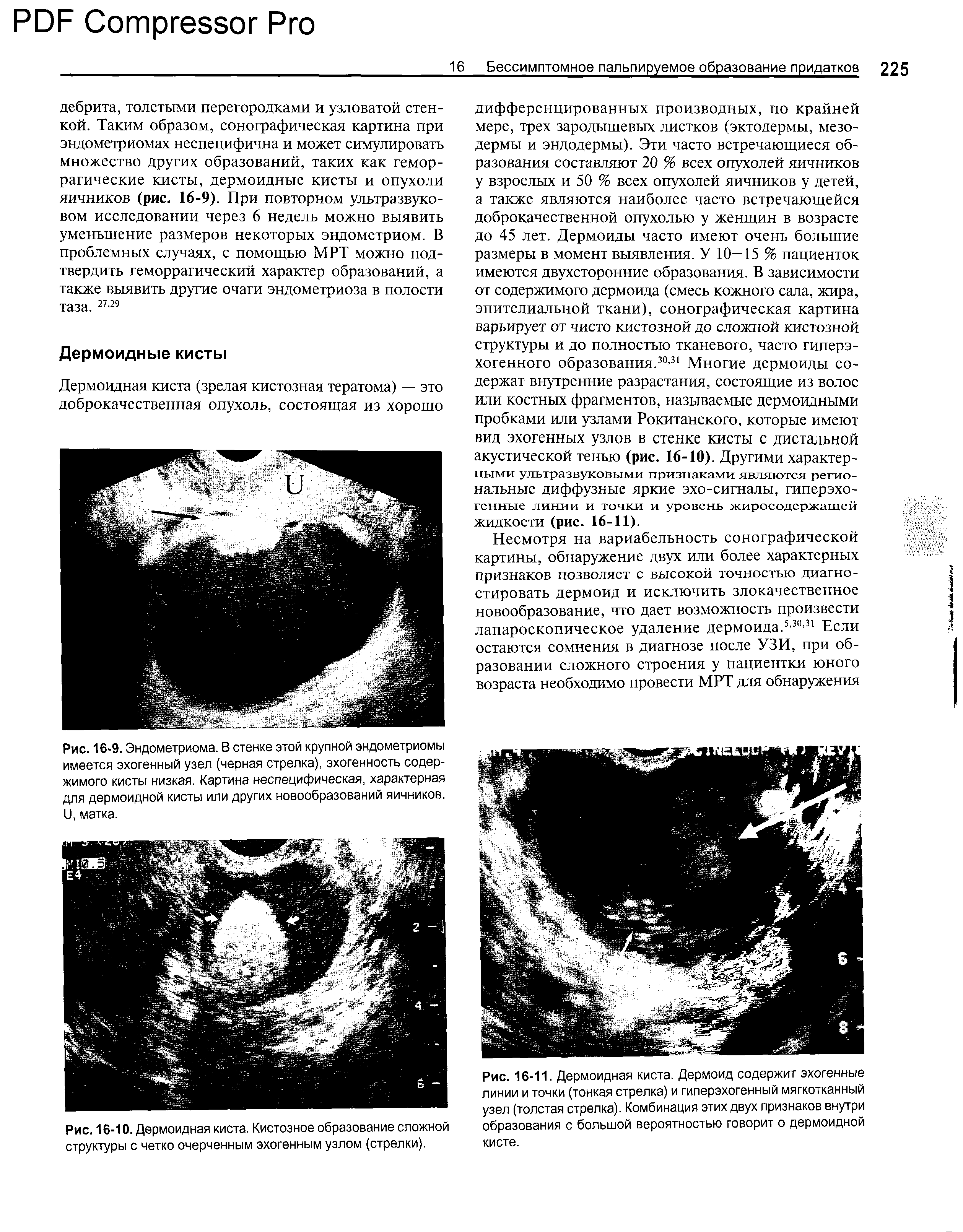 Рис. 16-9. Эндометриома. В стенке этой крупной эндометриомы имеется эхогенный узел (черная стрелка), эхогенность содержимого кисты низкая. Картина неспецифическая, характерная для дермоидной кисты или других новообразований яичников. I), матка.