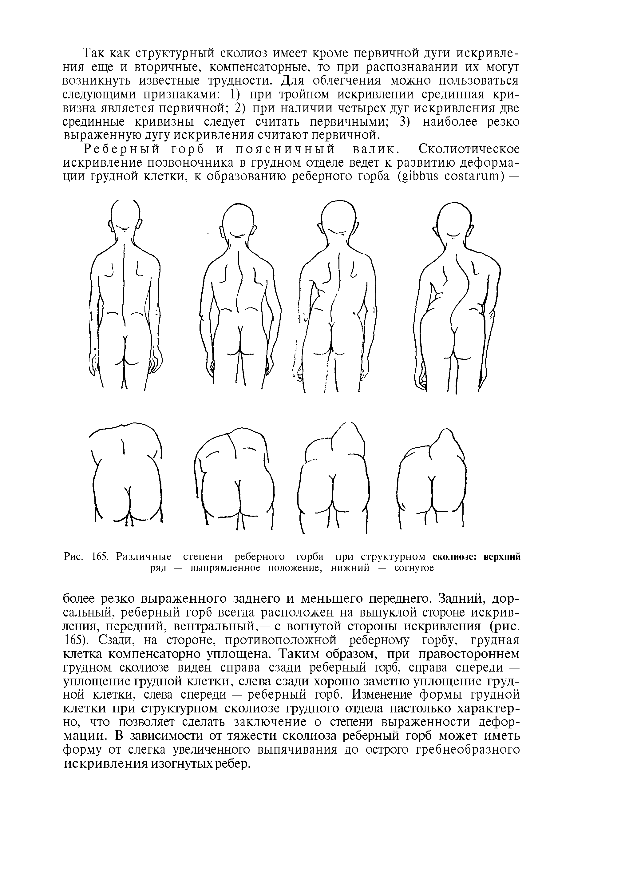 Рис. 165. Различные степени реберного горба при структурном сколиозе верхний ряд — выпрямленное положение, нижний — согнутое...