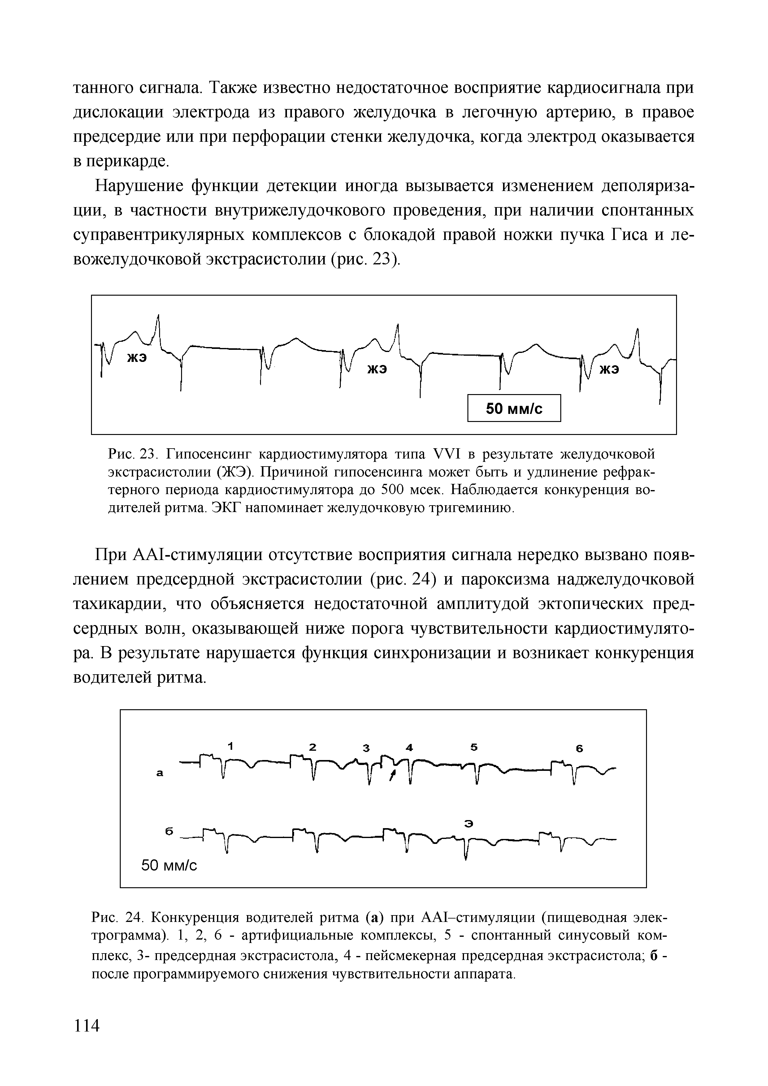 Рис. 24. Конкуренция водителей ритма (а) при АА1-стимуляции (пищеводная электрограмма). 1, 2, 6 - артифициальные комплексы, 5 - спонтанный синусовый комплекс, 3- предсердная экстрасистола, 4 - пейсмекерная предсердная экстрасистола б -после программируемого снижения чувствительности аппарата.