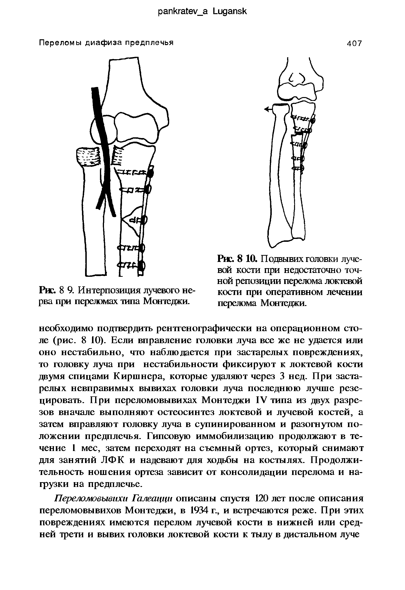 Рис. 8 9. Интерпозиция лучевого нерва при переломах типа Монтеджи.