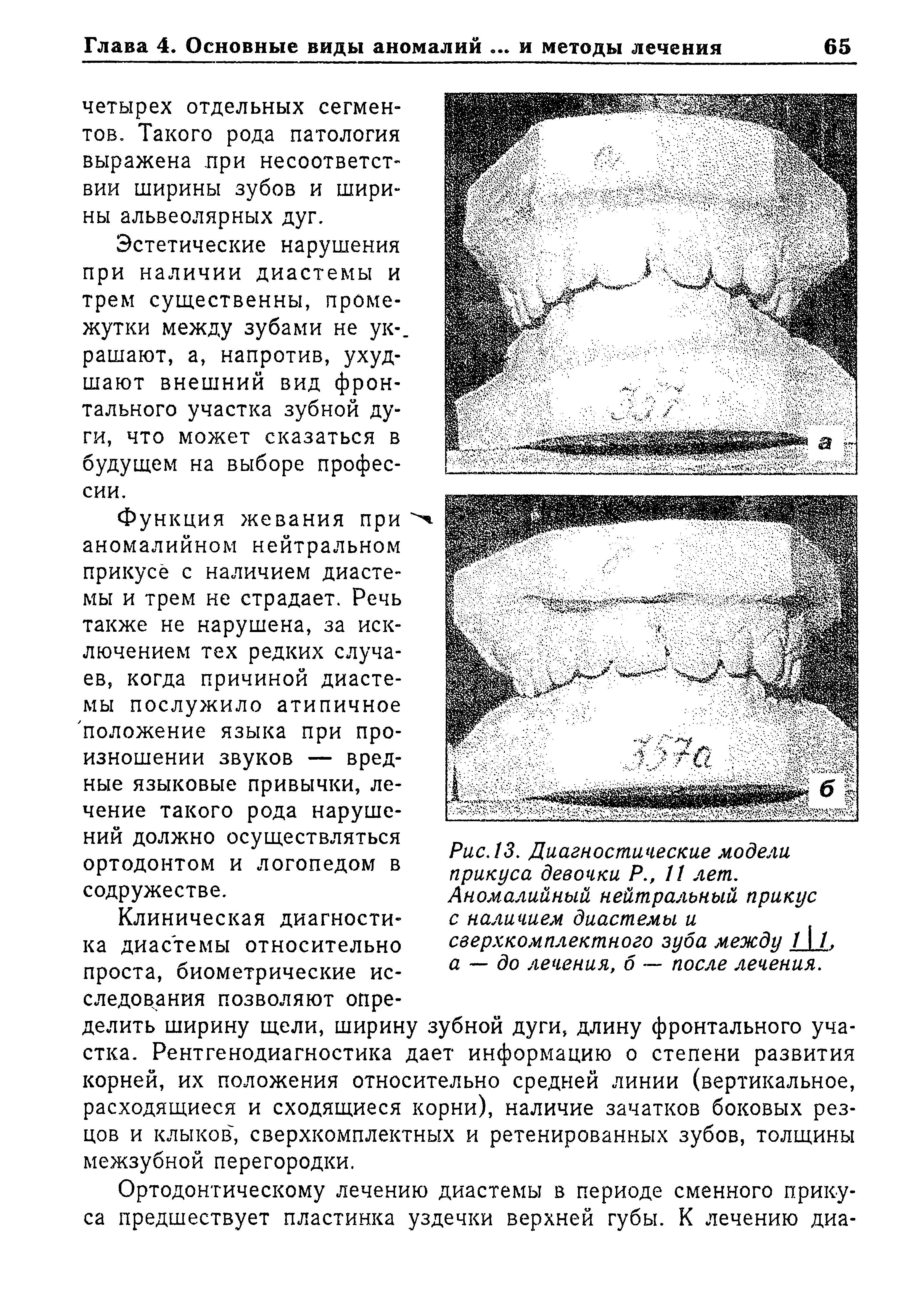 Рис.13. Диагностические модели прикуса девочки Р., 11 лет. Аномалийный нейтральный прикус с наличием диастемы и сверхкомплектного зуба между 111, а — до лечения, б — после лечения.