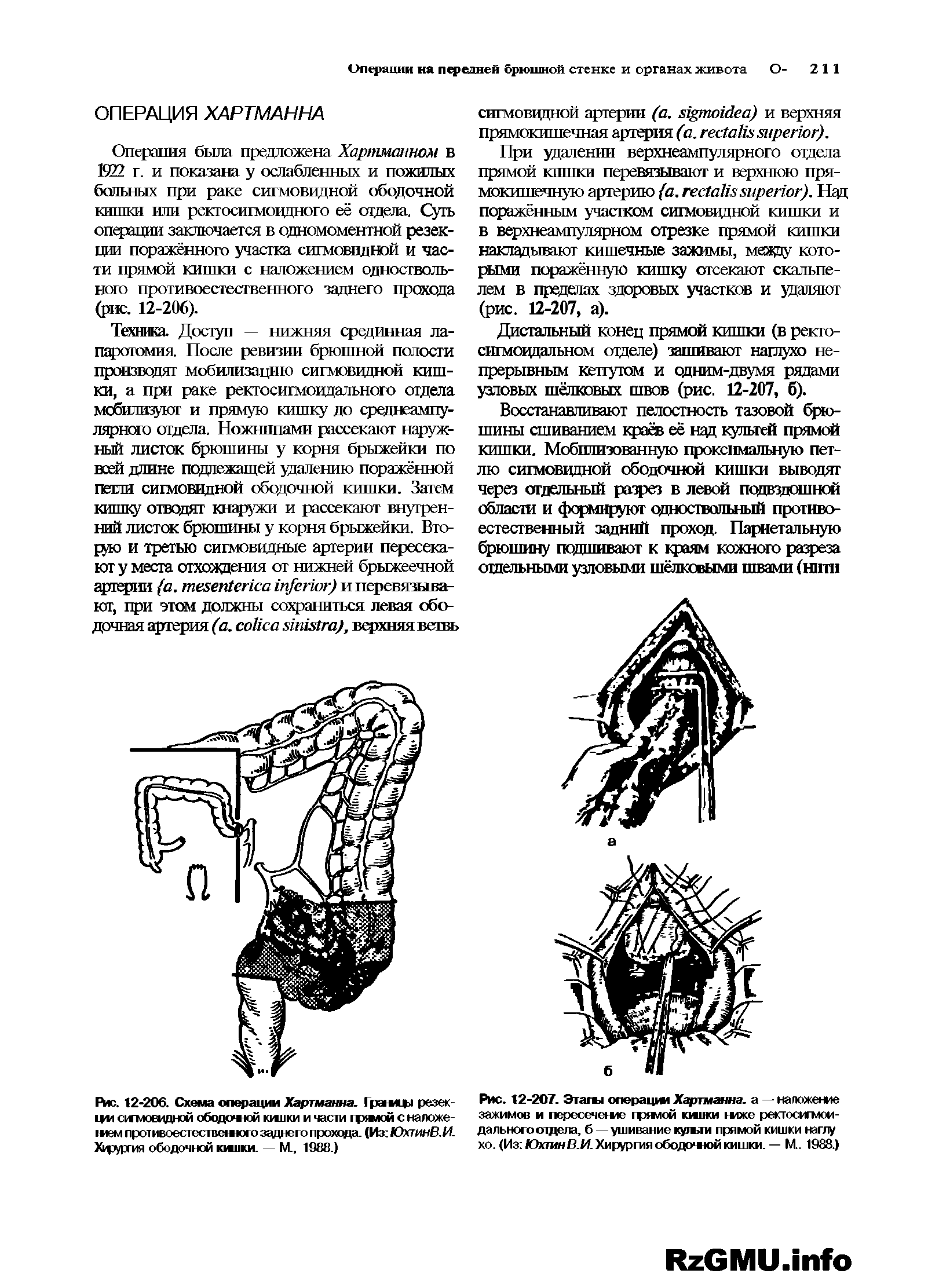 Рис. 12-207. Этагш операцю Хартманна, а - наложение зажимов и пересечете гряиой юшки тже ректосигмои-дальногоотдела, б —ушивание кулям прямой кишки наглу хо. (Из ЮхшнВ.И. Хирургия ободочюй кишки. — М. 1988.)...