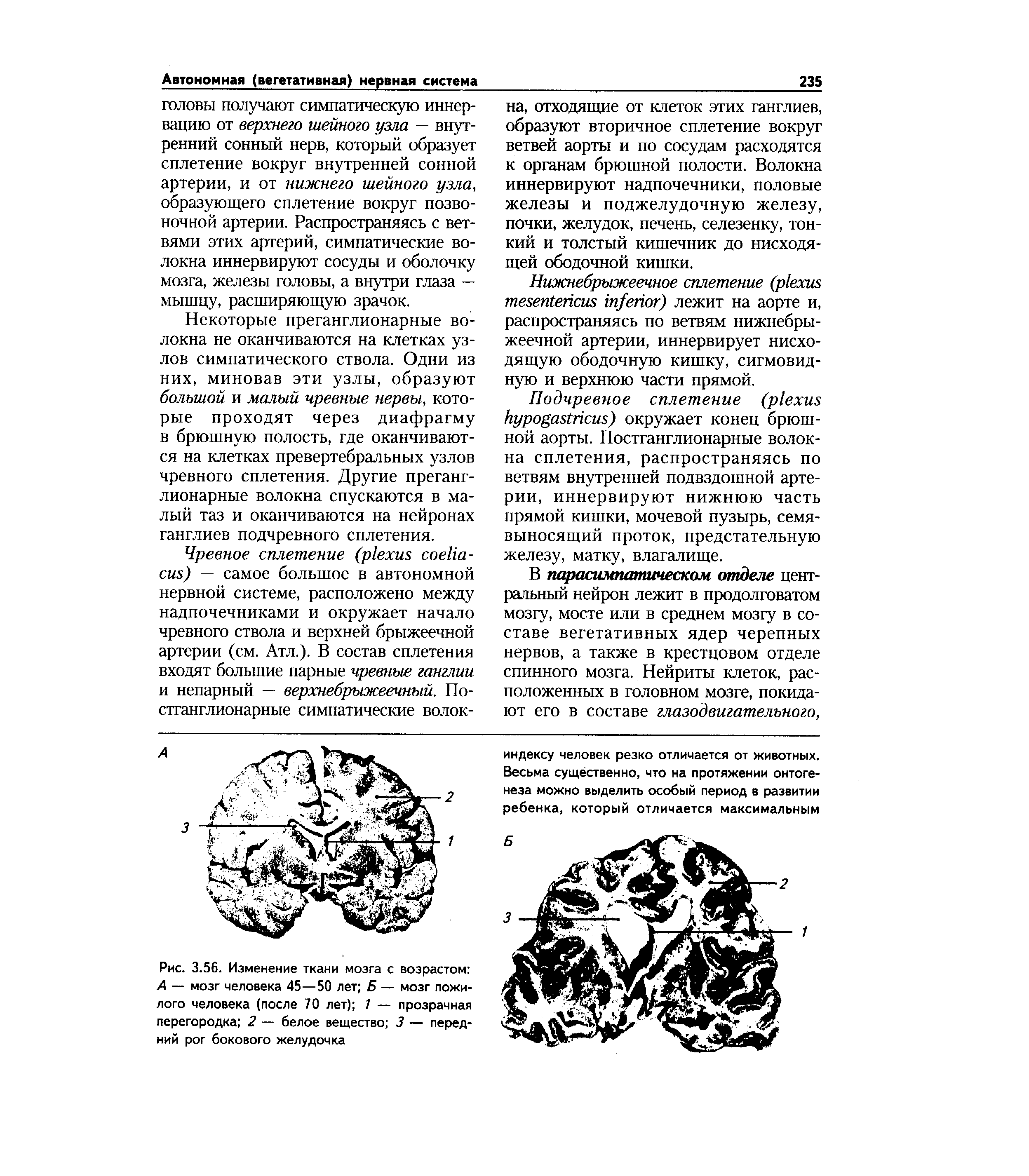 Рис. 3.56. Изменение ткани мозга с возрастом А — мозг человека 45—50 лет Б — мозг пожилого человека (после 70 лет) 1 — прозрачная перегородка 2 — белое вещество 3 — передний рог бокового желудочка...