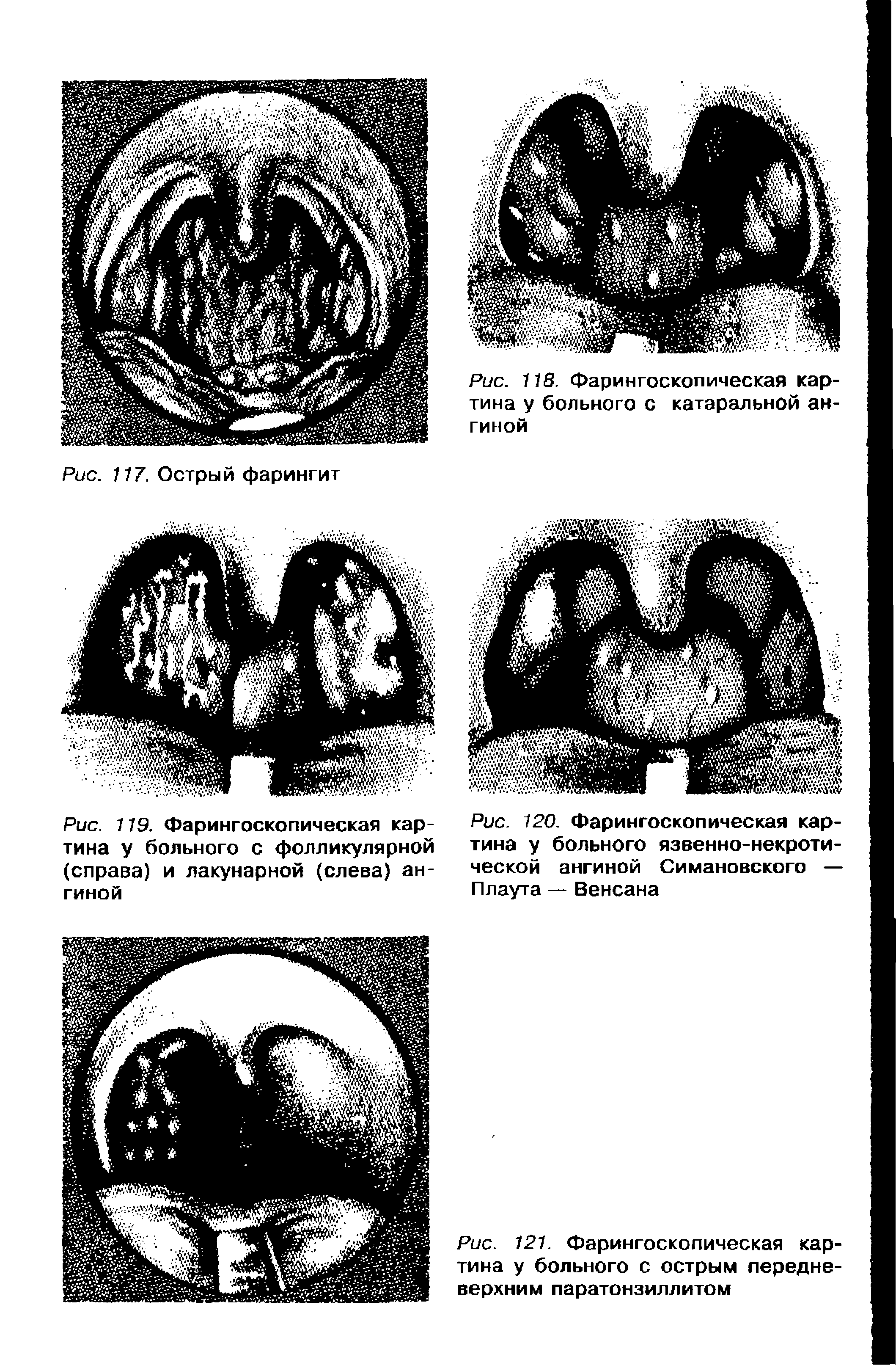 Рис. 120. Фарингоскопическая картина у больного язвенно-некротической ангиной Симановского — Плаута — Венсана...