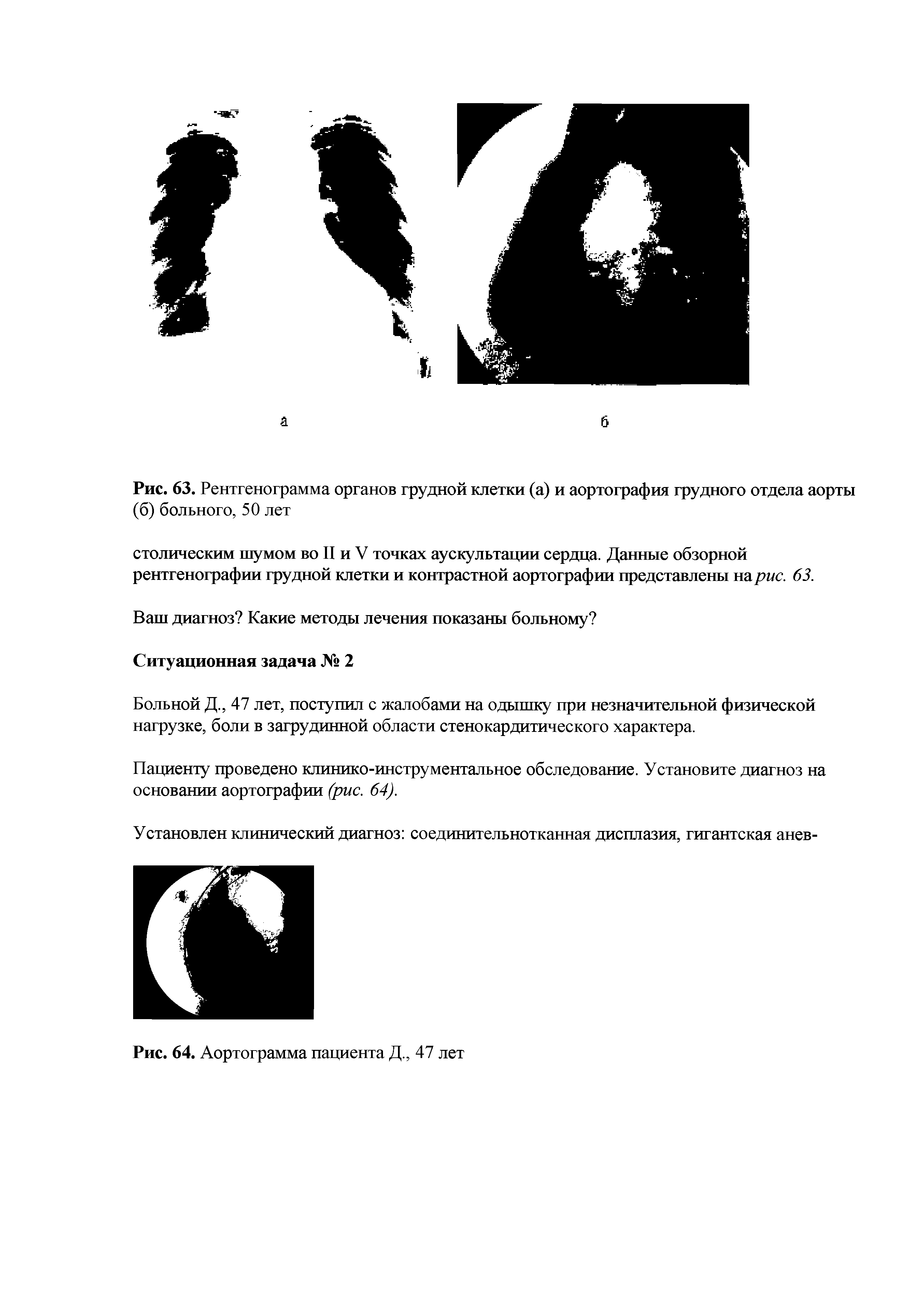 Рис. 63. Рентгенограмма органов грудной клетки (а) и аортография грудного отдела аорты (б) больного, 50 лет...