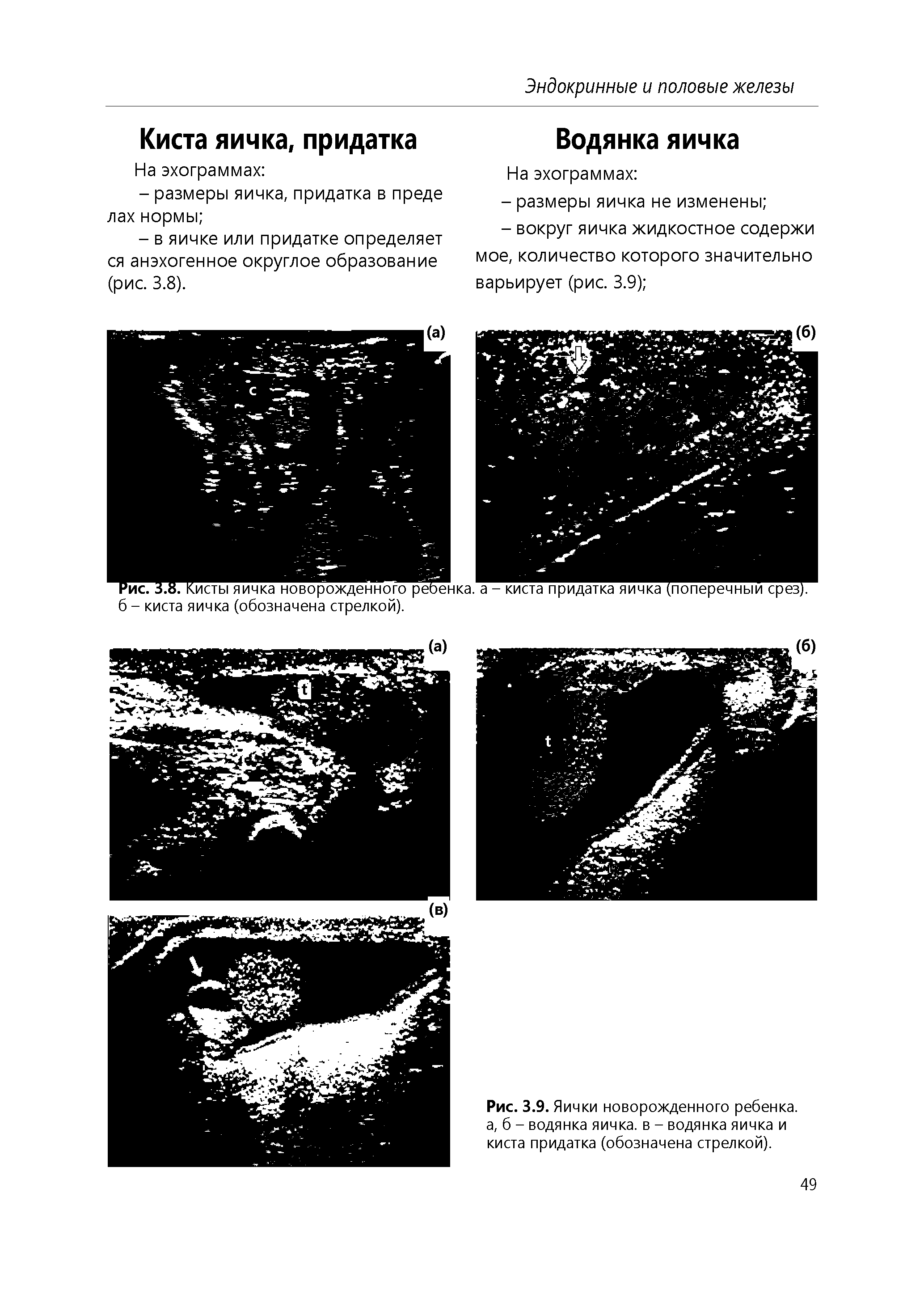 Рис. 3.8. Кисты яичка новорожден н о го реЬен к а. а - киста придатка яичка (поперечный срез), б - киста яичка (обозначена стрелкой).