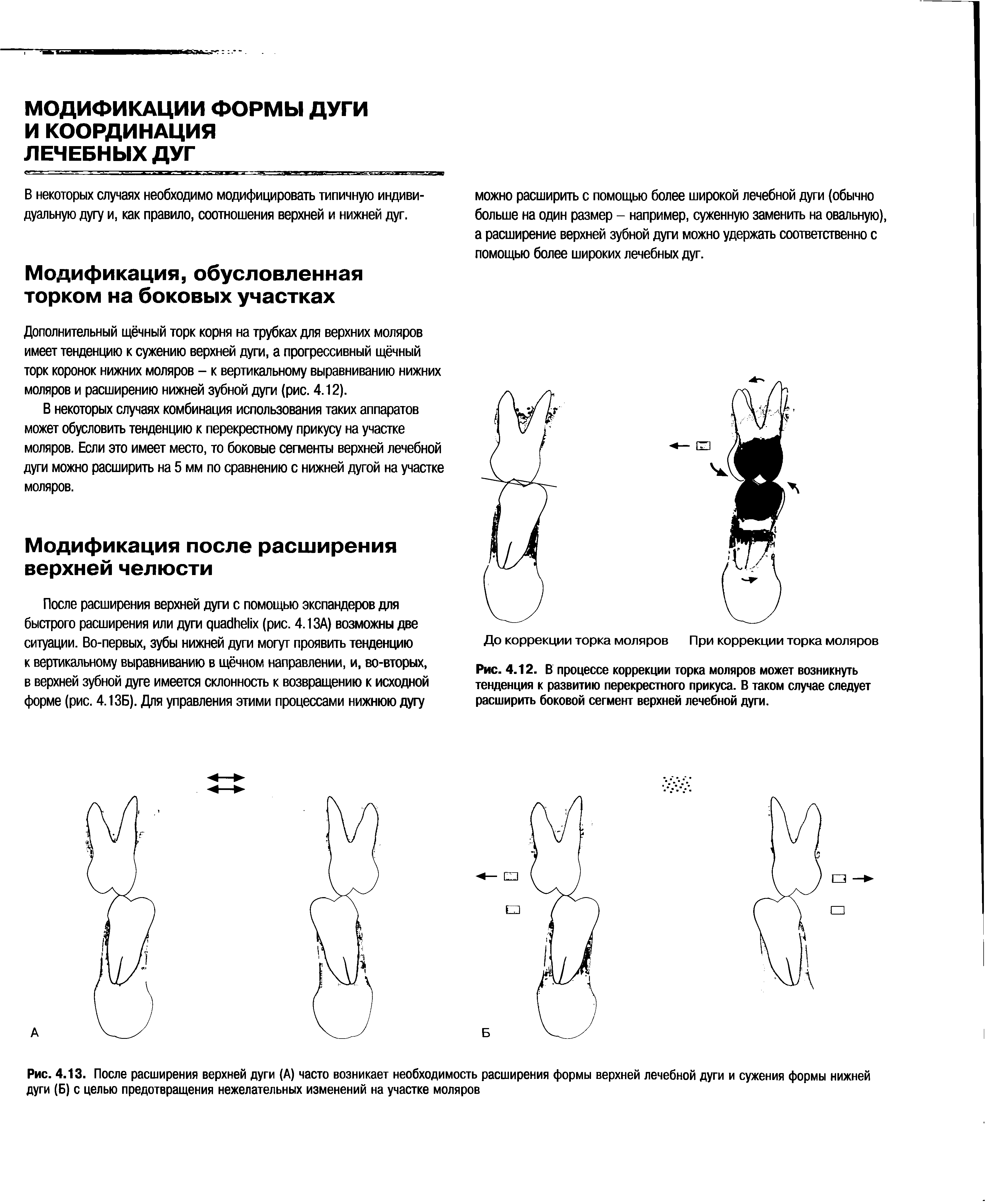 Рис. 4.13. После расширения верхней дуги (А) часто возникает необходимость расширения формы верхней лечебной дуги и сужения формы нижней дуги (Б) с целью предотвращения нежелательных изменений на участке моляров...