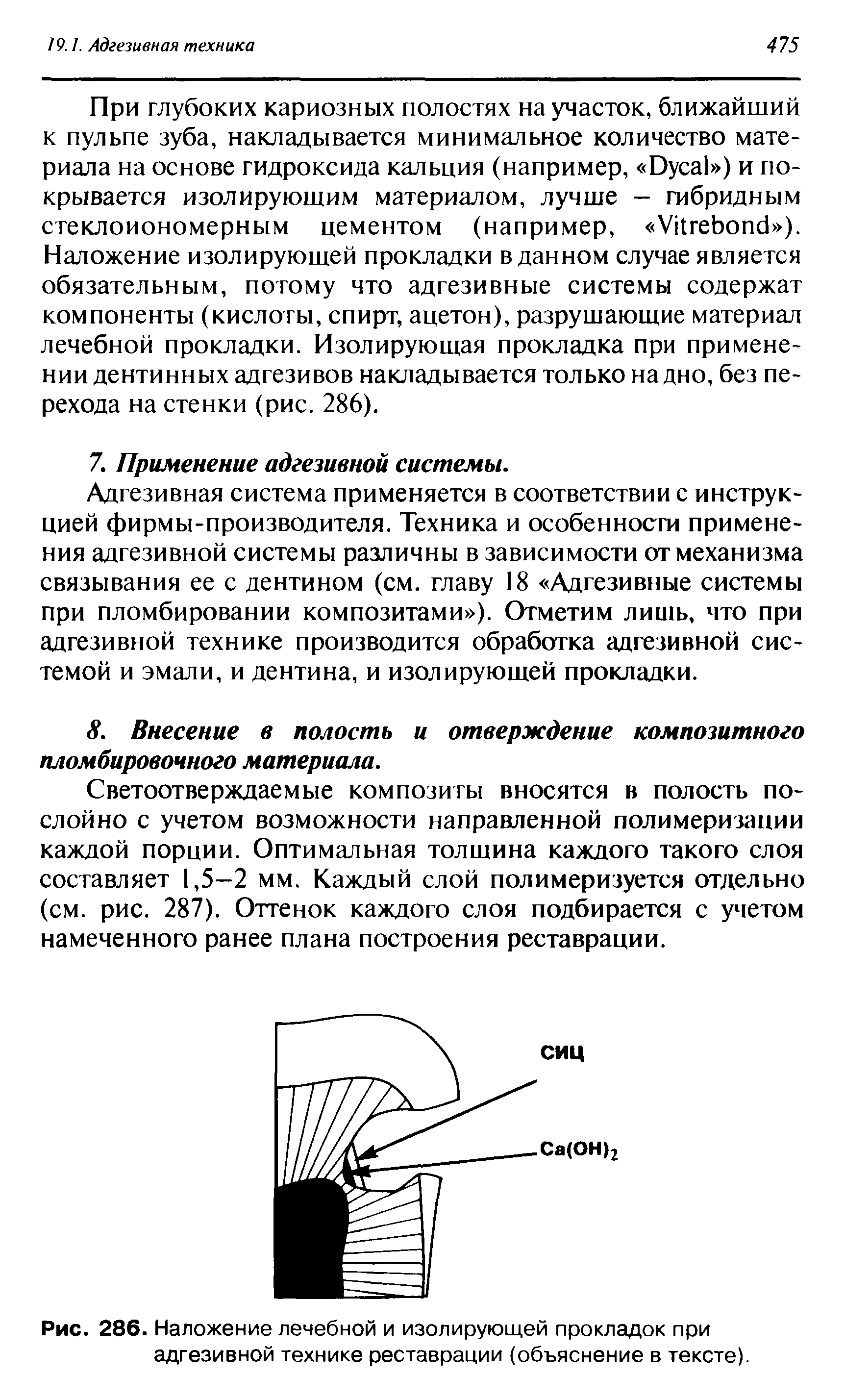 Рис. 286. Наложение лечебной и изолирующей прокладок при адгезивной технике реставрации (объяснение в тексте).