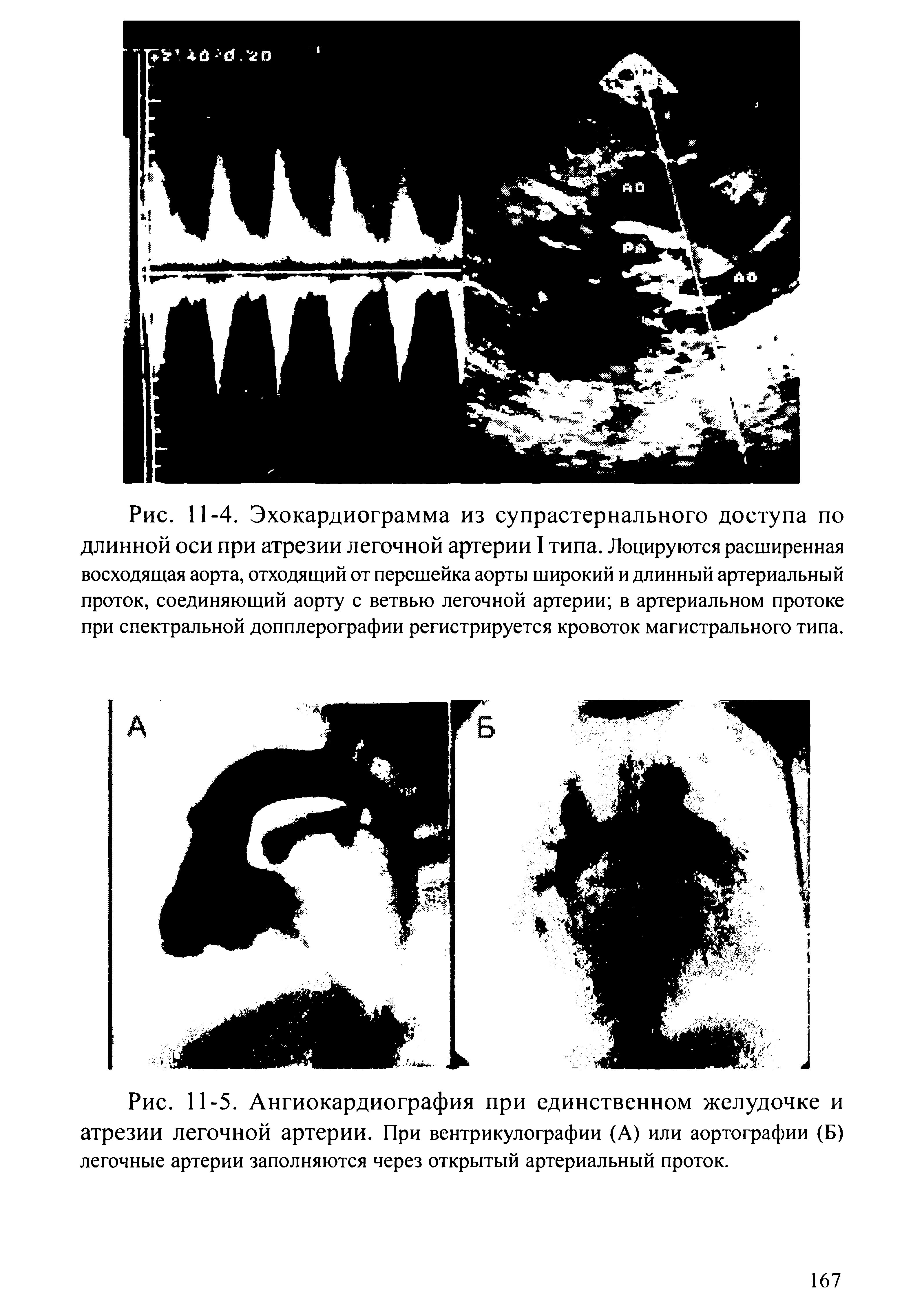 Рис. 11-5. Ангиокардиография при единственном желудочке и атрезии легочной артерии. При вентрикулографии (А) или аортографии (Б) легочные артерии заполняются через открытый артериальный проток.