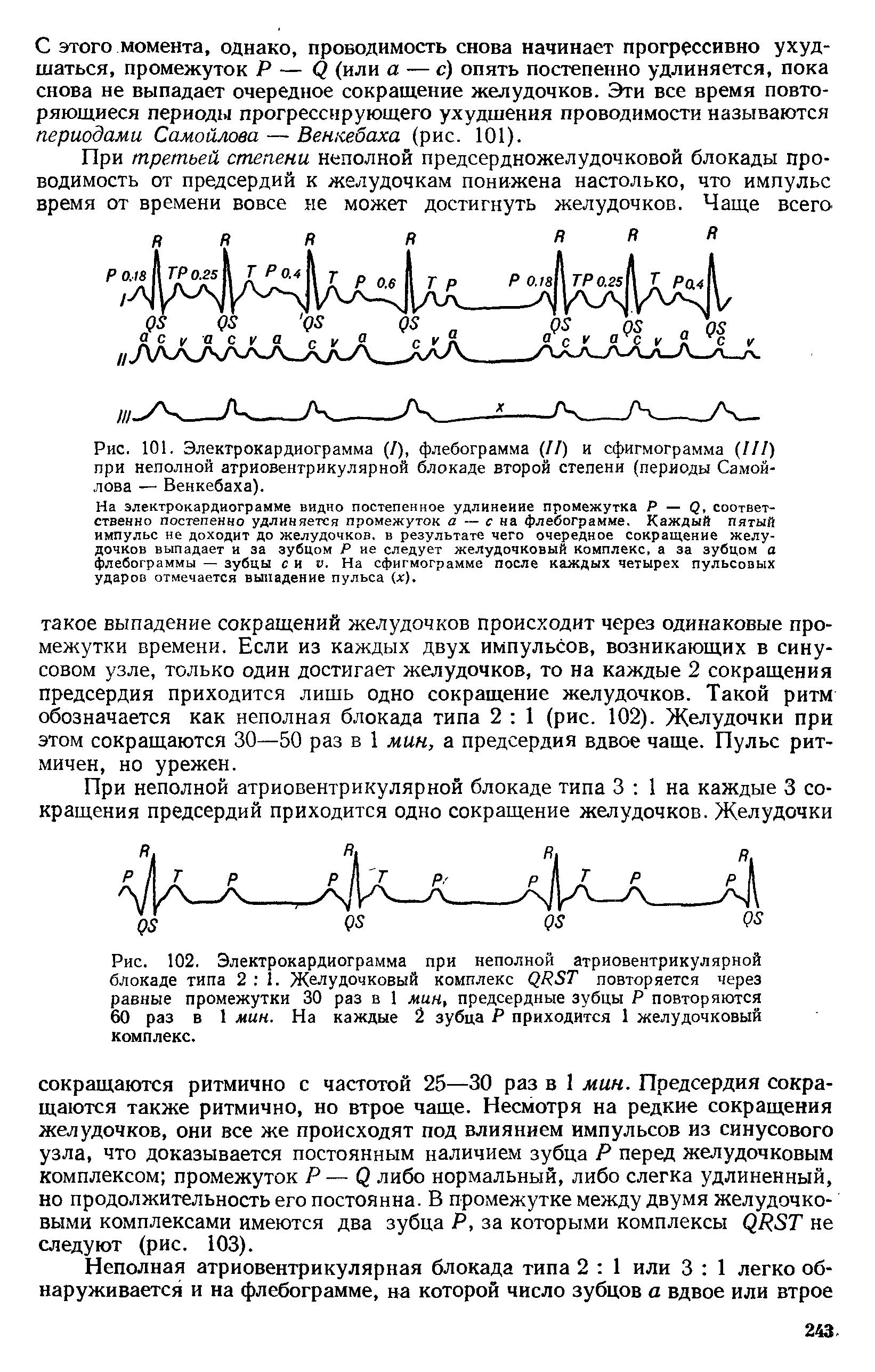 Рис. 101. Электрокардиограмма (/), флебограмма (II) и сфигмограмма (III) при неполной атриовентрикулярной блокаде второй степени (периоды Самойлова — Венкебаха).