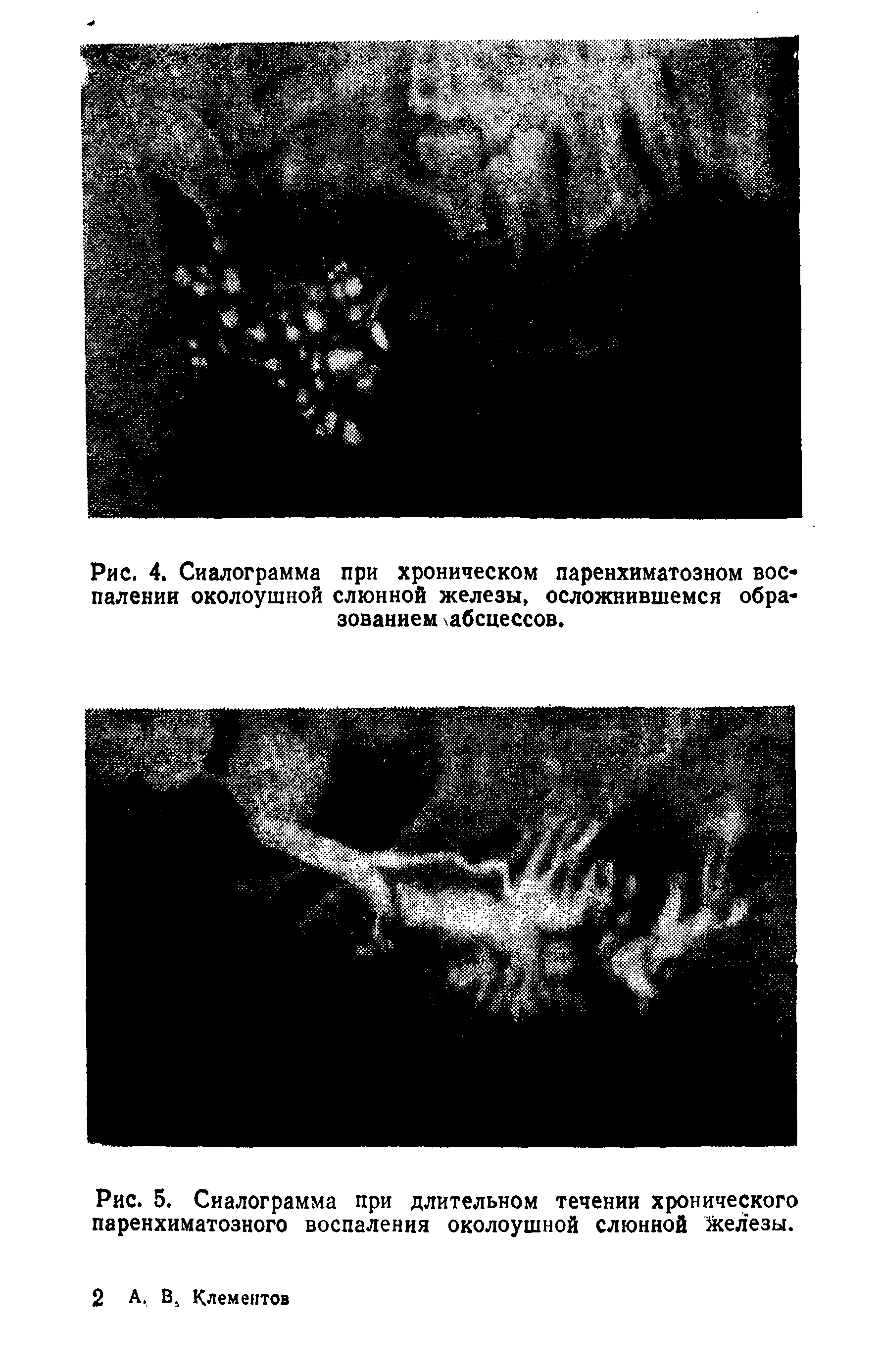 Рис. 5. Сиалограмма при длительном течении хронического паренхиматозного воспаления околоушной слюнной железы.