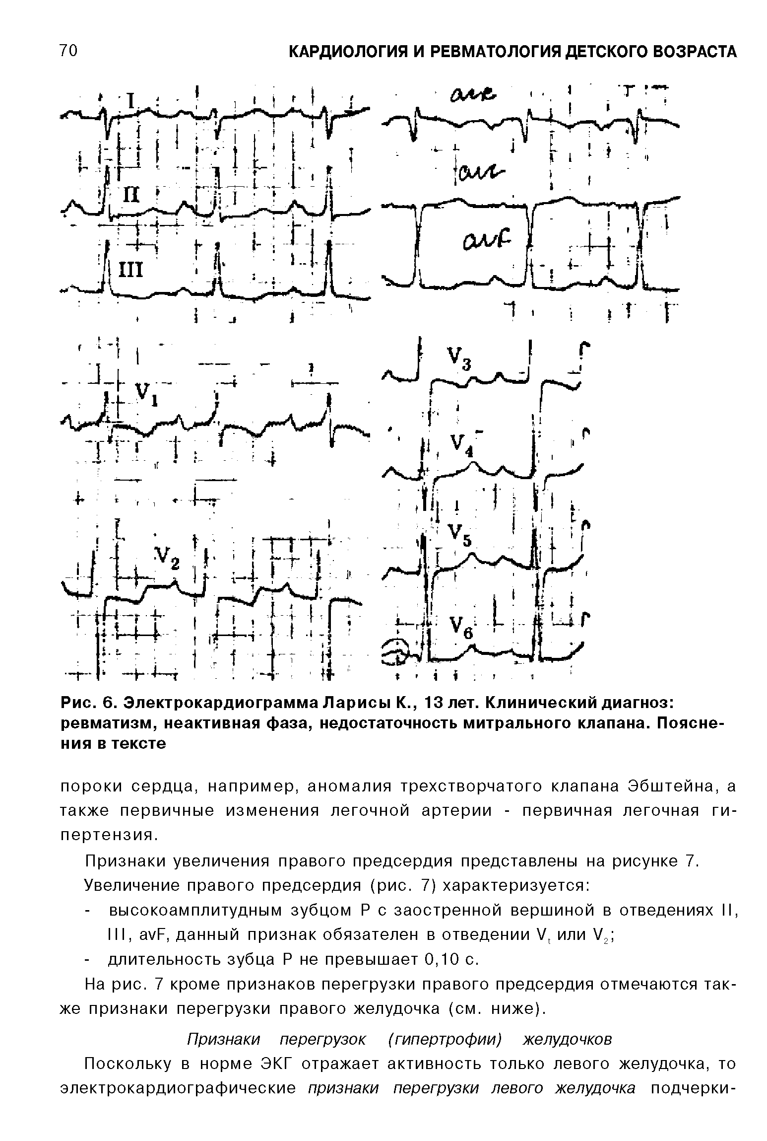 Рис. 6. Электрокардиограмма Ларисы К., 13 лет. Клинический диагноз ревматизм, неактивная фаза, недостаточность митрального клапана. Пояснения в тексте...