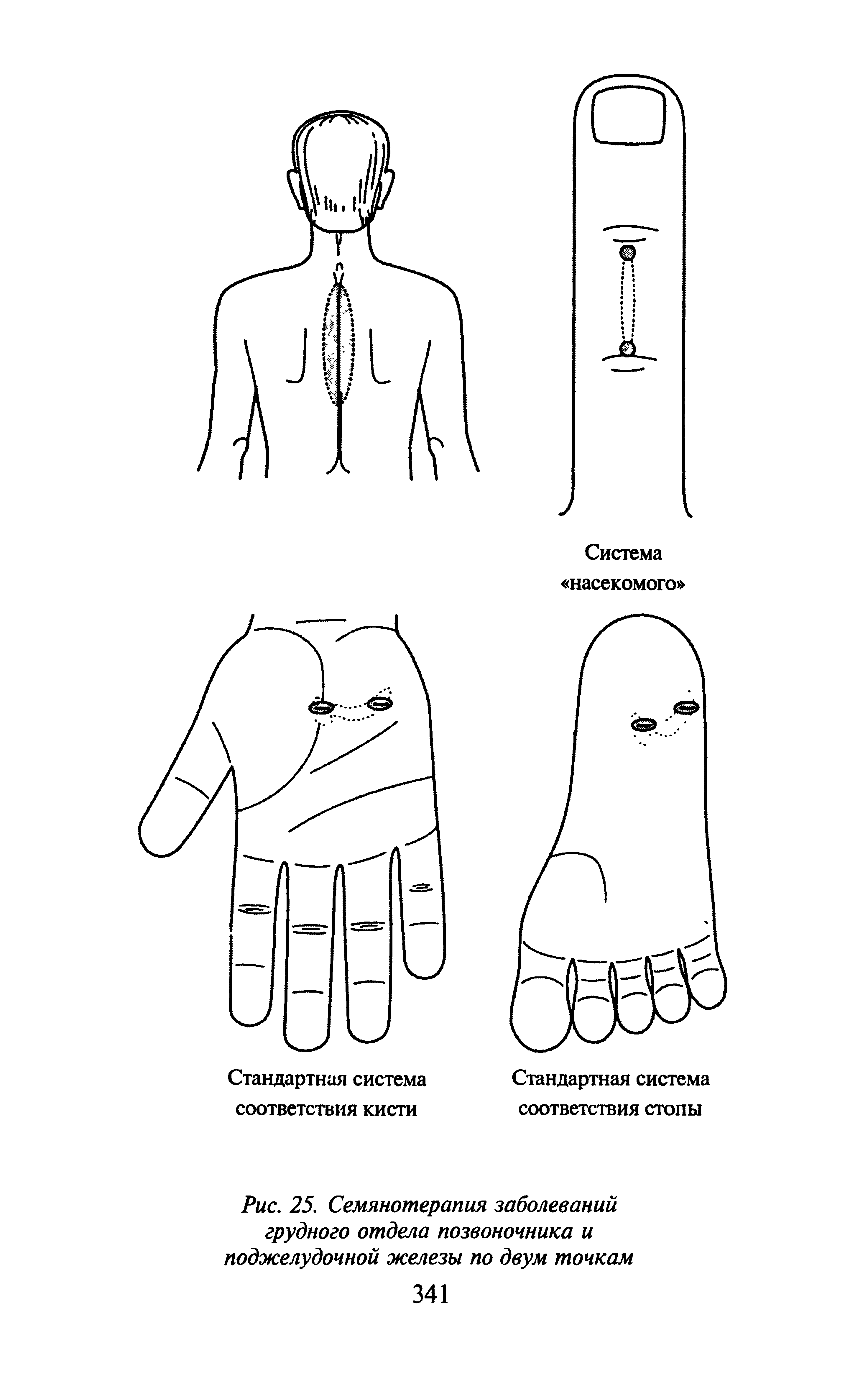 Рис. 25. Семянотерапия заболеваний грудного отдела позвоночника и поджелудочной железы по двум точкам...
